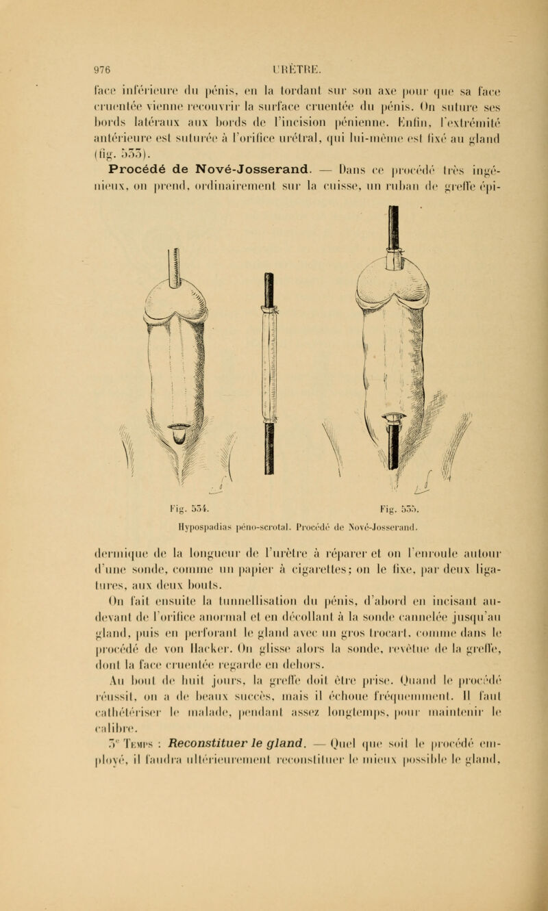 face inférieure du pénis, en la tordant sur son axe pour que sa face cruentée vienne recouvrir la surface cruentée du pénis. On suture ses bords latéraux aux bords de l'incision pénienne. Knfîn, l'extrémité antérieure est suturée à l'orifice urétral, qui lui-même est fixé au gland (fîg. 533). Procédé de Nové-Josserand. — Dans ce procédé très ingé- nieux, on prend, ordinairement sur la cuisse, un ruban de greffe épi- \ Fiu. 534 Fi! Hypospadias péno-scrotal. Procédé de Nové-Josserand. dermique de la longueur de l'urètre à réparer et on l'enroule autour d'une sonde, comme un papier à cigarettes; on le fixe, par deux liga- tures, aux deux bouts. On l'ail ensuite la tunnellisation du pénis, d'abord en ineisanl au- devant de l'orifice anormal et en décollant à la sonde cannelée jusqu'au gland, puis en perforant le gland avec un gros trocart, comme dans le procédé de von Hacker. On glisse alors la sonde, revêtue de la greffe, dont la lace cruentée regarde en dehors. Au boni de huit jours, la greffe (loiI être prise. Quand le procédé réussit, on a de beaux succès, mais il échoue fréquemment. Il faut cathétériser le malade, pendant assez longtemps, pour maintenir le calibre. 3e Temps : Reconstituer le gland. - Quel que soil le procédé em- ployé, il faudra ultérieurement reconstituer le mieux possible le gland,