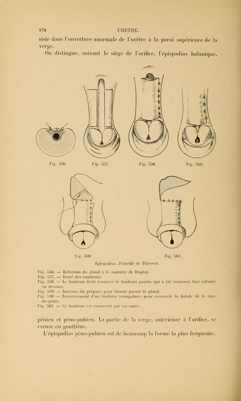 sisle dans l'ouverture anormale de l'urètre à la paroi supérieure de la verge. On distingue, suivant le siège de l'orifice, l'épispadias balanique, ig. 556. Fisr. 557. Fig. 558. Fiff. 559. Fig. 500. Fig. 501. Épispadias. Procédé de Thiersch. Fig. 556. — Réfection du gland à la manière de Duplay. I''i». 557.— Tracé dos lambeaux. Fig. 558. — Le lambeau droit recouvre le lambeau gauche qui a été renversé, face cutanée en dessous. Fig. 559. — Incision du prépuce pour laisser passer le gland. Fig. 5i)0.— Renversement d'un lambeau triangulaire pour recouvrir la lis tu le de la base du prilis. Fig. 561.— Ce lambeau est recouvert par [u^ autre. pénien ei péno-pubien. La partie de la verge, antérieure à l'orifice, se creuse en gouttière. L'épispadias péno-pubien esl de beaucoup la forme la plus fréquente.