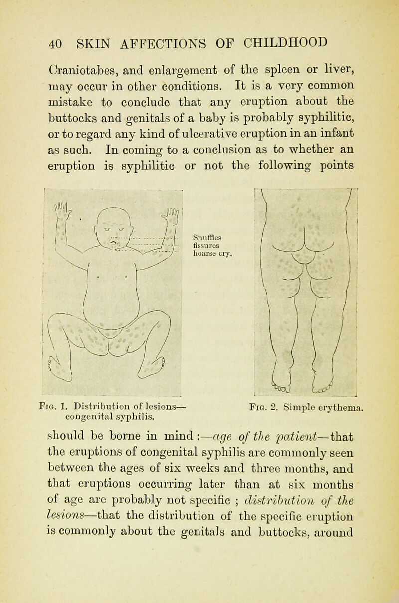 Craniotabes, and enlargement of the spleen or liver, may occur in other conditions. It is a very common mistake to conclude that any eruption about the buttocks and genitals of a baby is probably syphilitic, or to regard any kind of ulcerative eruption in an infant as such. In coming to a conclusion as to w^hether an eruption is syphilitic or not the following points Snuffles fissures hoarse cry. Pig. 1. Distribution of lesions- congenital syphilis. Fig. 2. Simple erythema. should be borne in mind :—age of the patient—that the eruptions of congenital syphilis are commonly seen between the ages of six weeks and three mouths, and that eruptions occurring later than at six months of age are probably not specific ; distribution of the letsions—that the distribution of the specific eruption is commonly about the genitals and buttocks, around