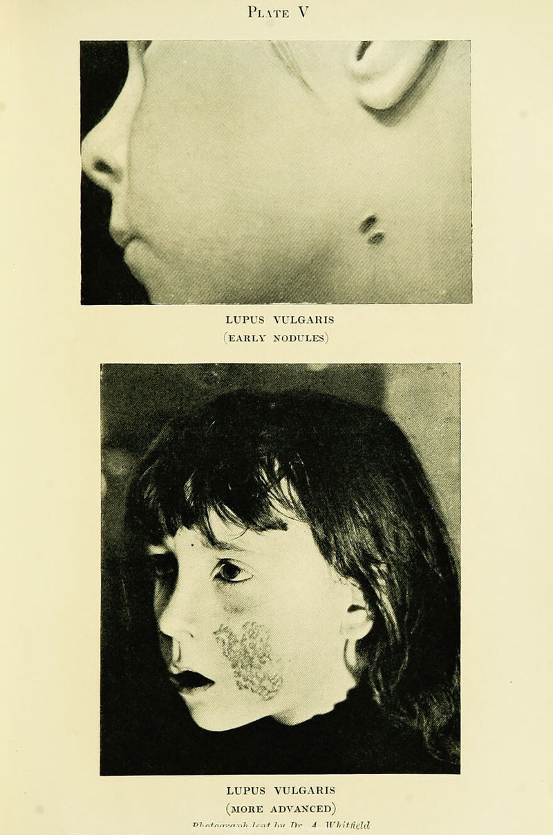 Plate V #. lupus vulgaris (early nodules) lupus vulgaris (more advanced)