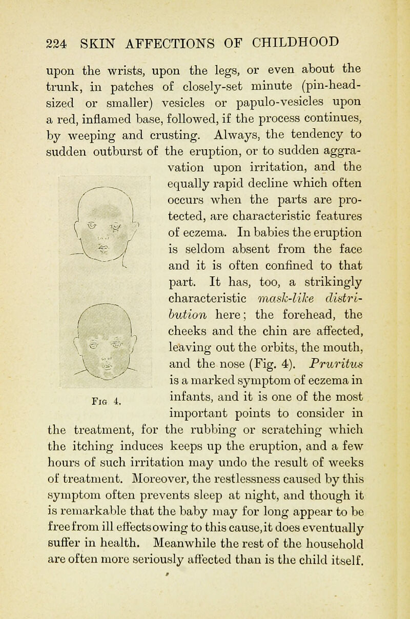upon the wrists, upon the legs, or even about the trunk, in patches of closely-set minute (pin-head- sized or smaller) vesicles or papulo-vesicles upon a red, inflamed base, followed, if the process continues, by weeping and crusting. Always, the tendency to sudden outburst of the eruption, or to sudden aggra- vation upon irritation, and the ^ ^ equally rapid decline which often / \ occurs when the parts are pro- J _ I tected, are characteristic features \ ,..,,'^ / of eczema. In babies the eruption _Jv -??■ / is seldom absent from the face 1^ and it is often confined to that part. It has, too, a strikingly characteristic mask-like distri- bution here; the forehead, the cheeks and the chin are affected, leaving out the orbits, the mouth, and the nose (Fig. 4). Pruritus is a marked symptom of eczema in Yjg 4 infants, and it is one of the most important points to consider in the treatment, for the rubbing or scratching which the itching induces keeps up the eruption, and a few hours of such irritation may undo the result of weeks of treatment. Moreover, the restlessness caused by this symptom often prevents sleep at night, and though it is remarkable that the baby may for long appear to be free from ill effects owing to this cause, it does eventually suffer in health. Meanwhile the rest of the household are often more seriously aflfected than is the child itself.