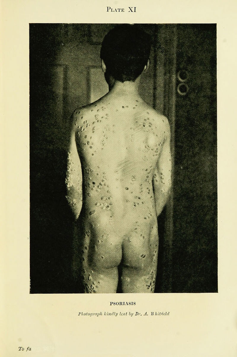 Plate XI PSORIASIS PltoiOQni2->h lindly lent hy Xir, A. If hitrield To fa