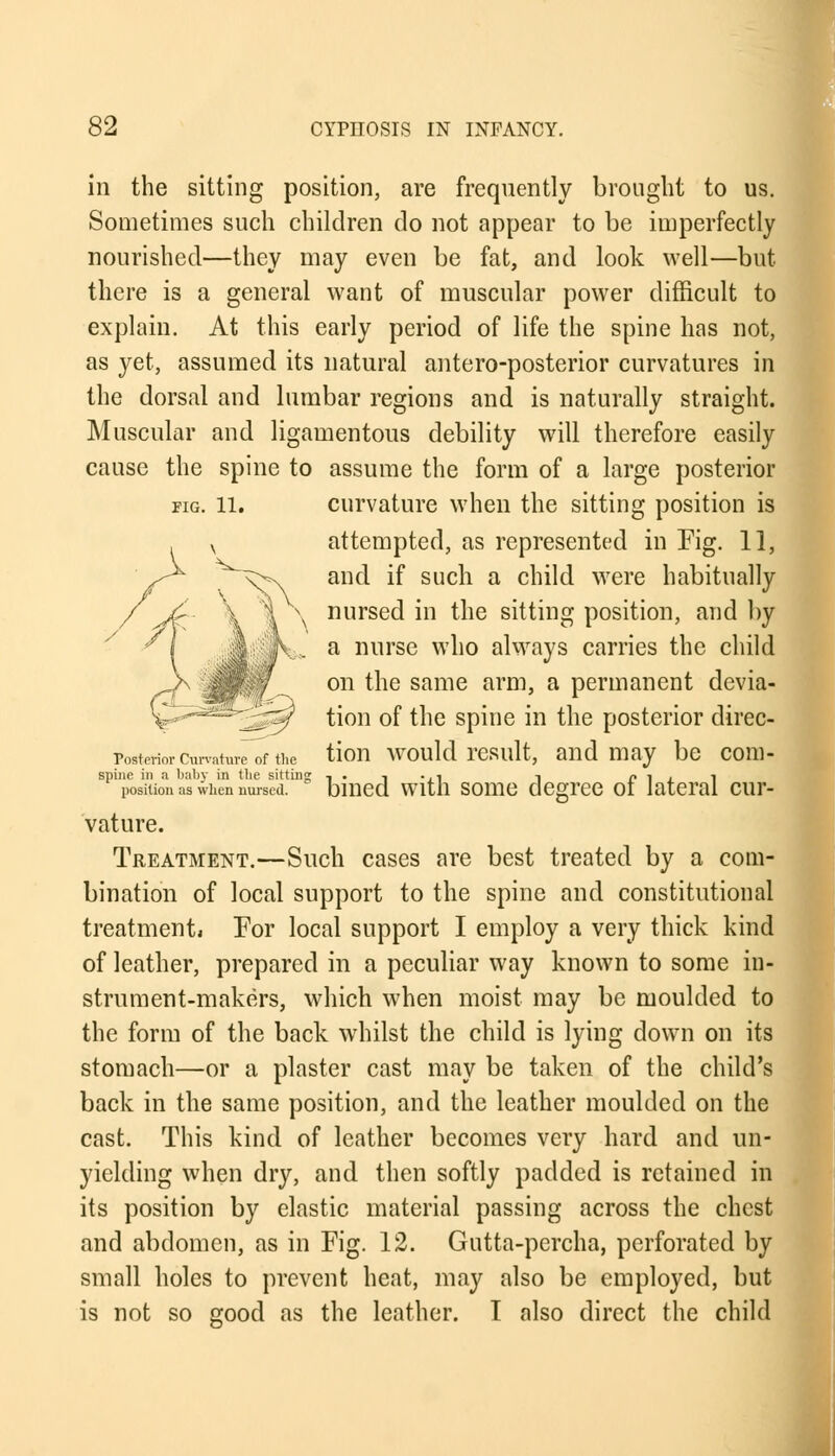 in the sitting position, are frequently brought to us. Sometimes such children do not appear to be imperfectly nourished—they may even be fat, and look well—but there is a general want of muscular power difficult to explain. At this early period of life the spine has not, as yet, assumed its natural antero-posterior curvatures in the dorsal and lumbar regions and is naturally straight. Muscular and ligamentous debility will therefore easily cause the spine to assume the form of a large posterior fig. 11. curvature when the sitting position is attempted, as represented in Fig. 11, and if such a child were habitually nursed in the sitting position, and by a nurse who always carries the child on the same arm, a permanent devia- tion of the spine in the posterior clirec- Posterio,-cm^re of ti,e tioii would result, and may be com- spine in a baby in the sitting -i-i-.il i piai position as when nursed, bmed with some degree oi lateral cur- vature. Treatment.—Such cases are best treated by a com- bination of local support to the spine and constitutional treatments For local support I employ a very thick kind of leather, prepared in a peculiar way known to some in- strument-makers, which when moist may be moulded to the form of the back whilst the child is lying clown on its stomach—or a plaster cast may be taken of the child's back in the same position, and the leather moulded on the cast. This kind of leather becomes very hard and un- yielding when dry, and then softly padded is retained in its position by elastic material passing across the chest and abdomen, as in Fig. 12. Gutta-percha, perforated by small holes to prevent heat, may also be employed, but is not so good as the leather. 1 also direct the child