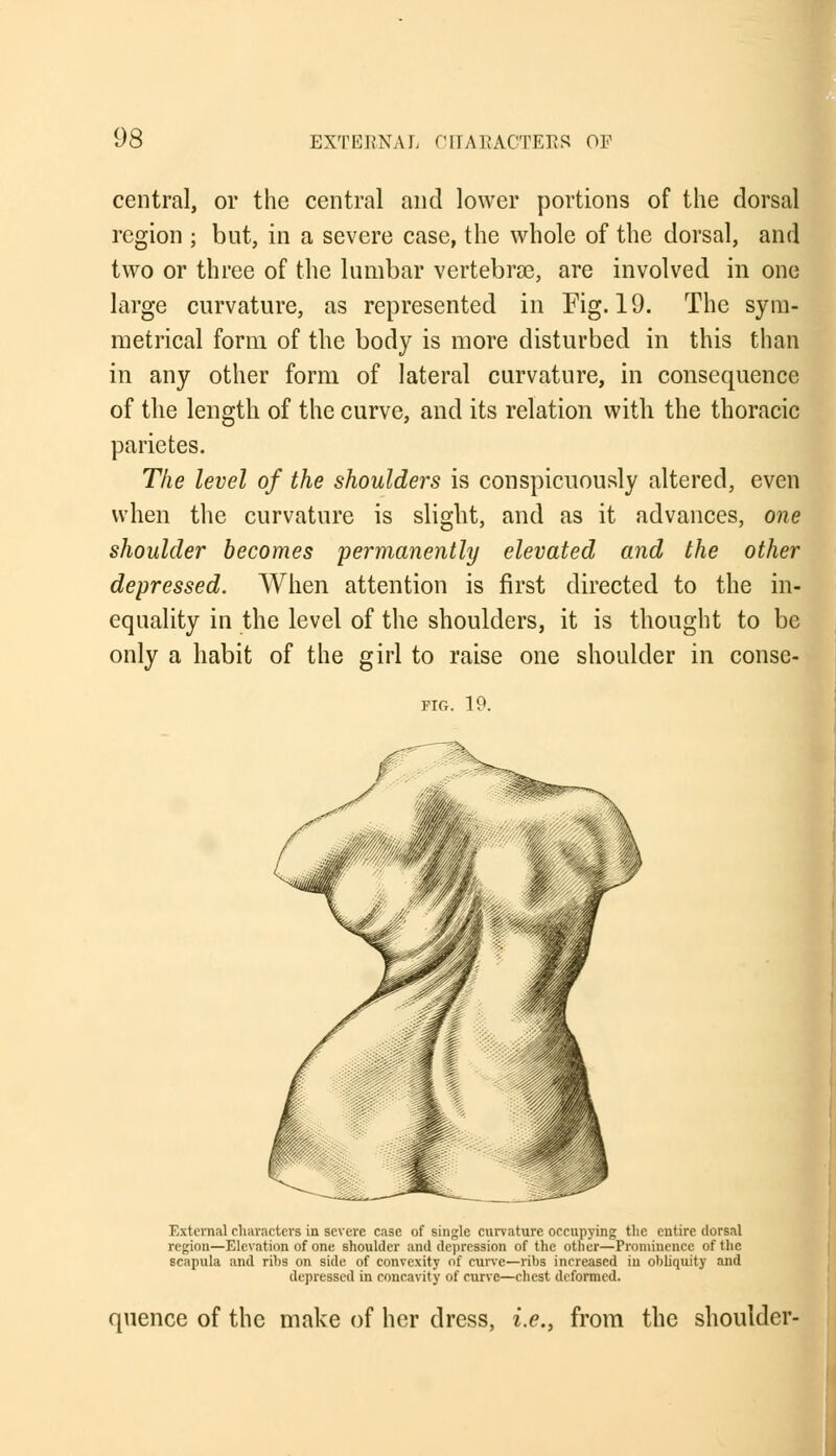 central, or the central and lower portions of the dorsal region ; but, in a severe case, the whole of the dorsal, and two or three of the lumbar vertebrae, are involved in one large curvature, as represented in Fig. 19. The sym- metrical form of the body is more disturbed in this than in any other form of lateral curvature, in consequence of the length of the curve, and its relation with the thoracic parietes. The level of the shoulders is conspicuously altered, even when the curvature is slight, and as it advances, one shoulder becomes permanently elevated and the other depressed. When attention is first directed to the in- equality in the level of the shoulders, it is thought to be only a habit of the girl to raise one shoulder in consc- FIG. 19. External characters in severe case of single curvature occupying the entire dorsal region—Elevation of one shoulder and depression of the other—Prominence of the scapula and ribs on side of convexity of curve—ribs increased in obliquity and depressed in concavity of curve—chest deformed. quence of the make of her dress, i.e., from the shoulder-