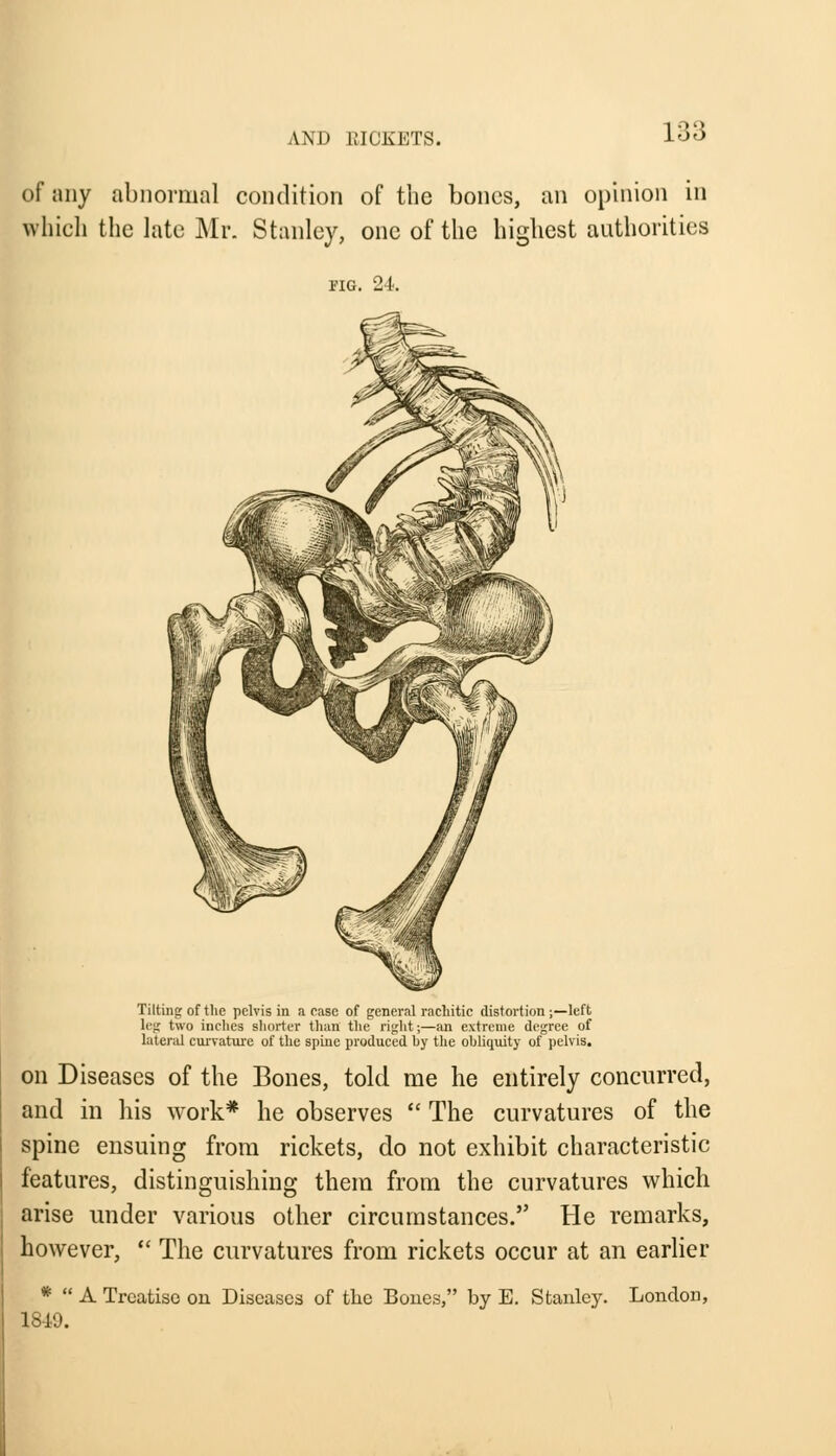 of nny abnormal condition of the bones, an opinion in which the late Mr. Stanley, one of the highest authorities FIG. 24.. Tilting of the pelvis in a ease of general rachitic distortion ;—left leg two inches shorter than the right;—an extreme degree of lateral curvature of the spine produced hy the obliquity of pelvis. on Diseases of the Bones, told me he entirely concurred, and in his work* he observes  The curvatures of the spine ensuing from rickets, do not exhibit characteristic features, distinguishing them from the curvatures which arise under various other circumstances. He remarks, however,  The curvatures from rickets occur at an earlier *  A Treatise on Diseases of the Bones, by E. Stanley. London, 1849.