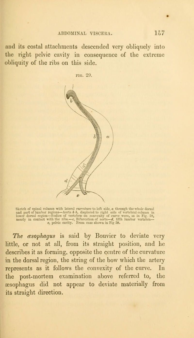 and its costal attachments descended very obliquely into the right pelvic cavity in consequence of the extreme obliquity of the ribs on this side. FIG. 29. Sketch of spinal column with lateral curvature to left side, a through the whole dorsal and part of lumbar regions—Aorta b b, displaced to right side of vertebral column in lower dorsal region—Bodies of vertebrae on convexity of curve were, as in Kg. 28, nearly in contact with the ribs.—c, Bifurcation of aorta—d, fifth lumbar vertebra— e, pelvic cavity. From case shown in Fig 38. The (esophagus is said by Bouvier to deviate very little, or not at all, from its straight position, and he describes it as forming, opposite the centre of the curvature in the dorsal region, the string of the bow which the artery represents as it follows the convexity of the curve. In the post-mortem examination above referred to, the oesophagus did not appear to deviate materially from its straight direction.