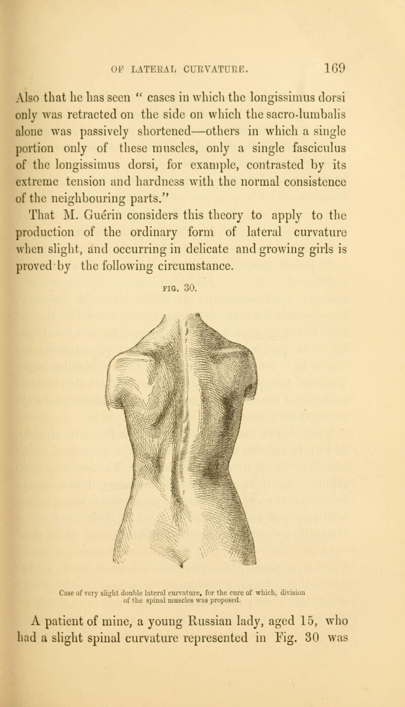 Also that he has seen  cases in which the longissinms dorsi only was retracted on the side on which the sacro-lnmbalis alone was passively shortened—others in which a single portion only of these muscles, only a single fasciculus of the longissinms dorsi, for example, contrasted by its extreme tension and hardness with the normal consistence of the neighbouring parts. That M. Guerin considers this theory to apply to the production of the ordinary form of lateral curvature when slight, and occurring in delicate and growing girls is proved by the following circumstance. FIG. 30. Case of very slight douhle lateral curvature, for the cure of which, division of the spinal muscles was proposed. A patient of mine, a young Russian lady, aged 15, who had a slight spinal curvature represented in Fig. 30 was
