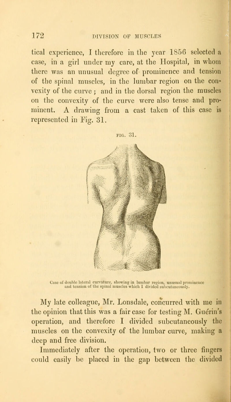 tical experience, I therefore in the year 1856 selected a case, in a girl under my care, at the Hospital, in whom there was an unusual degree of prominence and tension of the spinal muscles, in the lumbar region on the con- vexity of the curve ; and in the dorsal region the muscles on the convexity of the curve were also tense and pro- minent. A drawing from a cast taken of this case is represented in Pig. 31. FIG. 31. Case of double lateral curvature, showing in lumbar region, unusual prominence and tension of the spinal muscles which 1 divided subcutancoush/. My late colleague, Mr. Lonsdale, concurred with me in the opinion that this was a fair case for testing M. Guerin's operation, and therefore I divided subcutaneously the muscles on the convexity of the lumbar curve, making a deep and free division. Immediately after the operation, two or three fingers could easily be placed in the gap between the divided