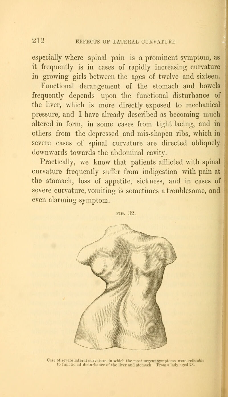 especially where spinal pain is a prominent symptom, as it frequently is in cases of rapidly increasing curvature in growing girls between the ages of twelve and sixteen. Functional derangement of the stomach and bowels frequently depends upon the functional disturbance of the liver, which is more directly exposed to mechanical pressure, and I have already described as becoming much altered in form, in some cases from tight lacing, and in others from the depressed and mis-shapen ribs, which in severe cases of spinal curvature are directed obliquely downwards towards the abdominal cavity. Practically, we know that patients afflicted with spinal curvature frequently suffer from indigestion with pain at the stomach, loss of appetite, sickness, and in cases of severe curvature, vomiting is sometimes a troublesome, and even alarming symptom. FIG. 32. Case of severe lateral curvature in which tlie most urgent symptoms were referable to functional disturbance of the liver and stomach. From a lady aged 23.