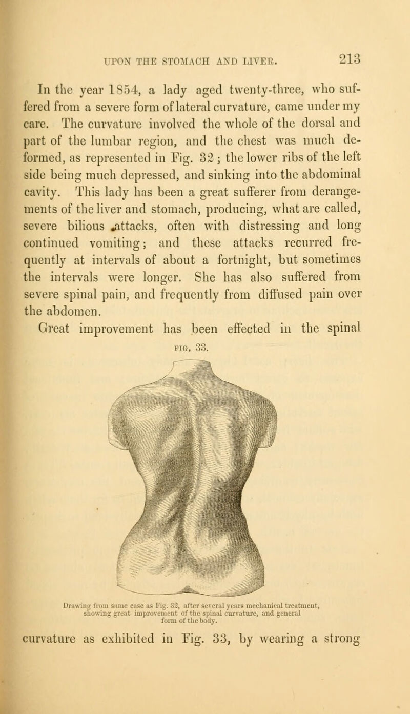I PON TIIE STOMACH AND LIVI.I;. In the year 1854, a lady aged twenty-three, who suf- fered from a severe form of lateral curvature, came under my care. The curvature involved the whole of the dorsal and part of the lumbar region, and the chest was much de- formed, as represented in Fig. 32 ; the lower ribs of the left side being much depressed, and sinking into the abdominal cavity. This lady has been a great sufferer from derange- ments of the liver and stomach, producing, what are called, severe bilious .attacks, often with distressing and long continued vomiting; and these attacks recurred fre- quently at intervals of about a fortnight, but sometimes the intervals were longer. She has also suffered from severe spinal pain, and frequently from diffused pain over the abdomen. Great improvement has been effected in the spinal FIG. 33. Drawing from same case as Fig. 32, after Beveral years mechanical treatment, siluwing great improvement of the spinal curvature, and general form of the body. curvature as exhibited in Fig. 33, by wearing a strong