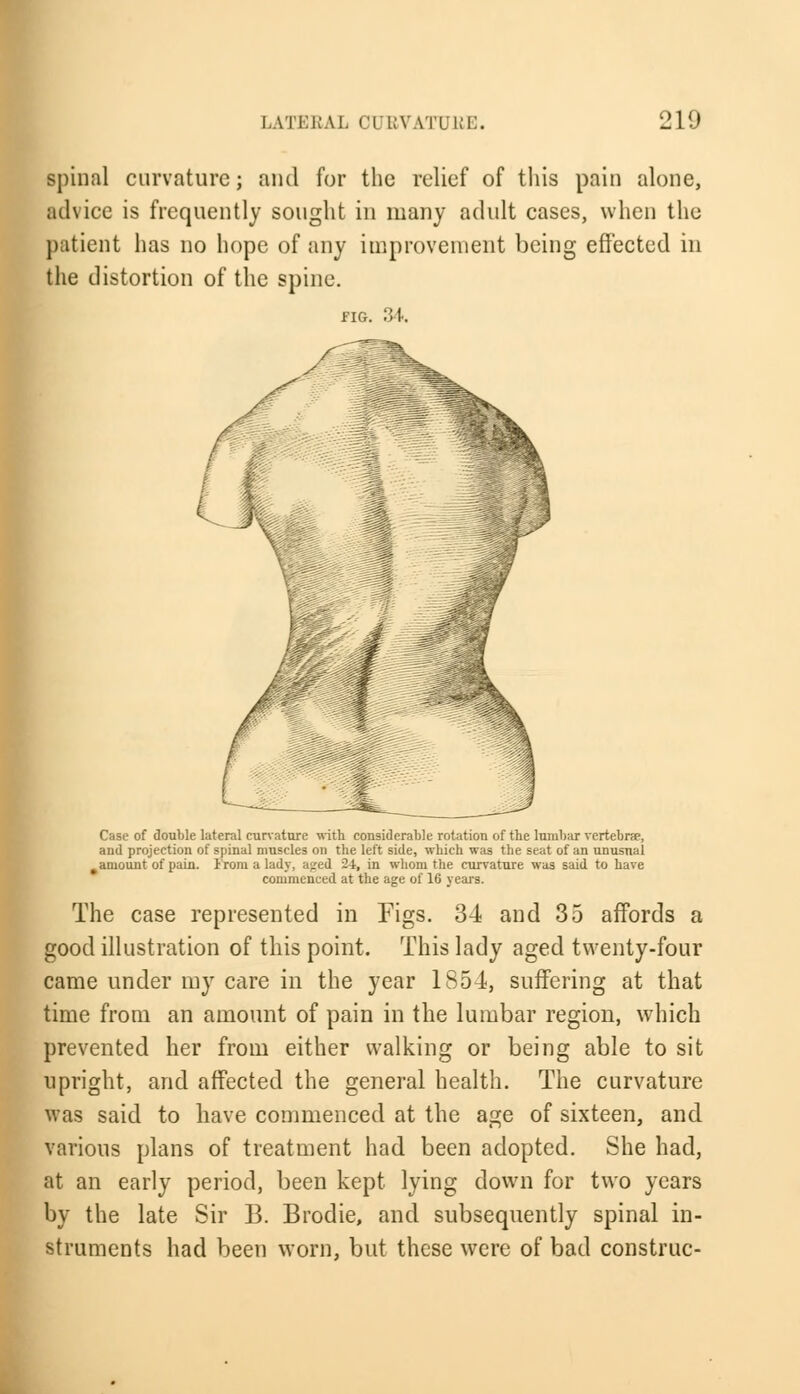 spinal curvature; and for the relief of this pain alone, advice is frequently sought in many adult cases, when the patient has no hope of any improvement being effected in the distortion of the spine. FIG. 34. Ml Case of double lateral curvature with considerable rotation of the lumbar vertebrae, and projection of spinal muscles on the left side, which was the seat of an unusual amount of pain. From a lady, aged 24, in whom the curvature was said to have commenced at the age of 16 years. The case represented in Figs. 34 and 35 affords a good illustration of this point. This lady aged twenty-four came under my care in the year 1854, suffering at that time from an amount of pain in the lumbar region, which prevented her from either walking or being able to sit upright, and affected the general health. The curvature was said to have commenced at the age of sixteen, and various plans of treatment had been adopted. She had, at an early period, been kept lying down for two years by the late Sir B. Brodie, and subsequently spinal in- struments had been worn, but these were of bad construe-