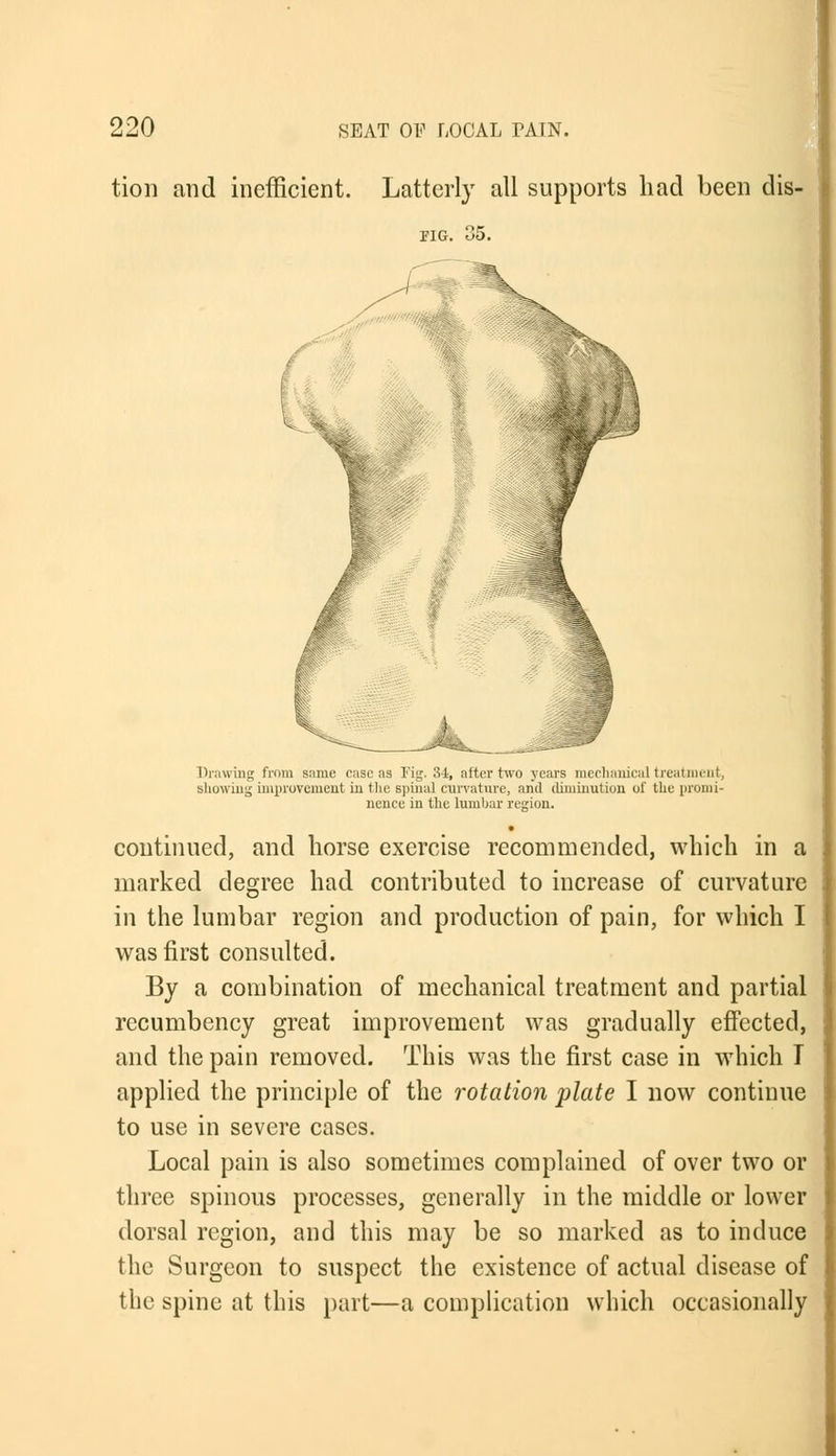 tion and inefficient. Latterly all supports had been dis- pig. 35. Drawing from same case as Fig. 34, after two years mechanical treatment, showing improvement in the spinal curvature, and diminution of the promi- nence in the lumbar region. continued, and horse exercise recommended, which in a marked degree had contributed to increase of curvature in the lumbar region and production of pain, for which I was first consulted. By a combination of mechanical treatment and partial recumbency great improvement was gradually effected, and the pain removed. This was the first case in which T applied the principle of the rotation plate I now continue to use in severe cases. Local pain is also sometimes complained of over two or three spinous processes, generally in the middle or lower dorsal region, and this may be so marked as to induce the Surgeon to suspect the existence of actual disease of the spine at this part—a complication which occasionally