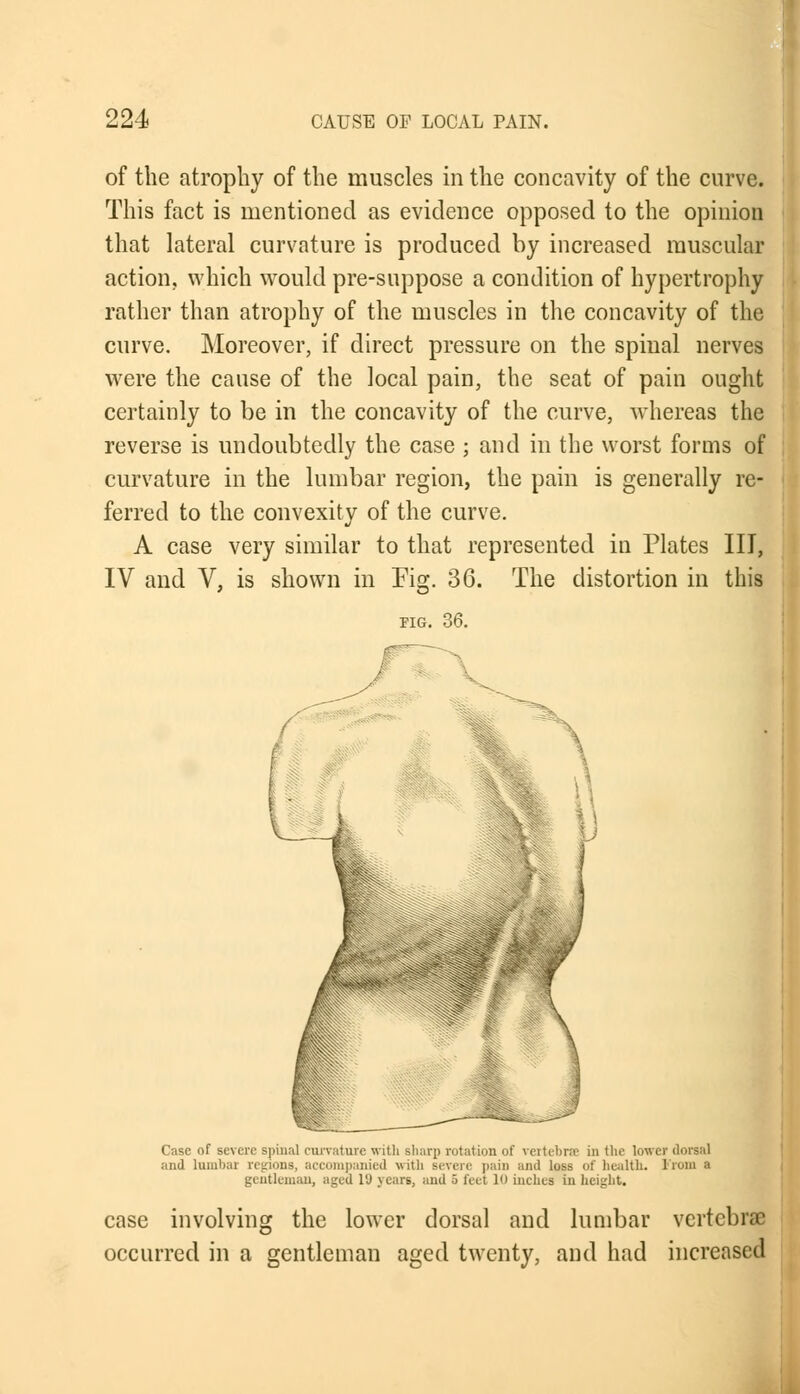 of the atrophy of the muscles in the concavity of the curve. This fact is mentioned as evidence opposed to the opinion that lateral curvature is produced by increased muscular action, which would pre-snppose a condition of hypertrophy rather than atrophy of the muscles in the concavity of the curve. Moreover, if direct pressure on the spinal nerves were the cause of the local pain, the seat of pain ought certainly to be in the concavity of the curve, whereas the reverse is undoubtedly the case ; and in the worst forms of curvature in the lumbar region, the pain is generally re- ferred to the convexity of the curve. A case very similar to that represented in Plates III, IV and V, is shown in Fig. 36. FIG. 36. The distortion in this Case of severe spinal curvature with sharp rotation of vertebrae in the lower dorsal and lumbar regions, accompanied with severe pain and loss of health. From a gentleman, aged 19 years, and 5 feet 10 inches in height. case involving the lower dorsal and lumbar vertebrae occurred in a gentleman aged twenty, and had increased