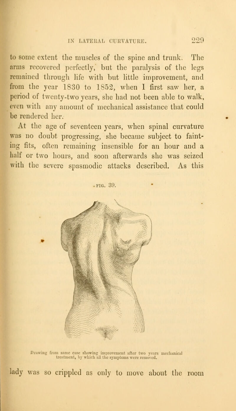 to sonic extent the muscles of the spine and trunk. The inns recovered perfectly, but the paralysis of the legs remained through life with but little improvement, and from the year 1830 to 1S52, when 1 first saw her, a period of twenty-two years, she had not been able to walk, even with any amount of mechanical assistance that could be rendered her. At the age of seventeen years, when spinal curvature was no doubt progressing, she became subject to faint- ing fits, often remaining insensible for an hour and a half or two hours, and soon afterwards she was seized with the severe spasmodic attacks described. As this -FIG. 39. Drawing from same case showing improvement after two years mechanical treatment, by which all the symptoms were removed. lady was so crippled as only to move about the room
