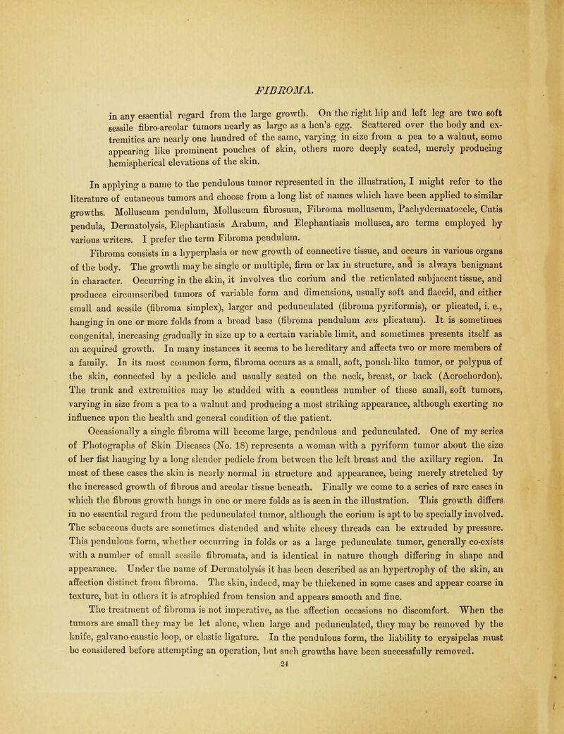in any essential regard from the large growth. On the right hip and left leg are two soft 6essile fibro-areolar tumors nearly as large as a hen's egg. Scattered over the body and ex- tremities are nearly one hundred of the same, varying in size from a pea to a walnut, some appearing like prominent pouches of skin, others more deeply seated, merely producing hemispherical elevations of the skin. In applying a name to the pendulous tumor represented in the illustration, I might refer to the literature of cutaneous tumors and choose from a long list of names which have been applied to similar growths. Molluscum pendulum, Molluscum fibrosum, Fibroma molluscum, Pachydermatocele, Cutis pendula, Dermatolysis, Elephantiasis Arabum, and Elephantiasis mollusca, are terms employed by various writers. I prefer the term Fibroma pendulum. Fibroma consists in a hyperplasia or new growth of connective tissue, and occurs in various organs of the body. The growth may be single or multiple, firm or lax in structure, and is always benignant in character. Occurring in the skin, it involves the corium and the reticulated subjacent tissue, and produces circumscribed tumors of variable form and dimensions, usually soft and flaccid, and cither small and sessile (fibroma simplex), larger and pedunculated (fibroma pyriformis), or plicated, i. e., bulging in one or more folds from a broad base (fibroma pendulum sen plicatum). It is sometimes congenital, increasing gradually in size up to a certain variable limit, and sometimes presents itself as an acquired growth. In many instances it seems to be hereditary and affects two or more members of a family. In its most common form, fibroma occurs as a small, soft, pouch-like tumor, or polypus of the skin, connected by a pedicle and usually seated on the neck, breast, or back (Aerochordon). The trunk and extremities may be studded with a countless number of these small, soft tumors, varying in size from a pea to a walnut and producing a most striking appearance, although exerting no influence upon the health and general condition of the patient. Occasionally a single fibroma will become large, pendulous and pedunculated. One of my scries of Photographs of Skin Diseases (No. 18) represents a woman with a pyriform tumor about the size of her fist hanging by a long slender pedicle from between the left breast and the axillary region. In most of these cases the skin is nearly normal in structure and appearance, being merely stretched by the increased growth of fibrous and areolar tissue beneath. Finally we come to a series of rare cases in which the fibrous growth hangs in one or more folds as is seen in the illustration. This growth differs in no essential regard from the pedunculated tumor, although the corium is apt to bo specially involved. The sebaceous ducts arc sometimes distended and white cheesy threads can be extruded by pressure. This pendulous form, whether occurring in folds or as a large pedunculate tumor, generally co-exists with a number of small sessile fibromata, and is identical in nature though differing in shape and appearance. Under the name of Dermatolysis it has been described as an hypertrophy of the skin, an affection distinct from fibroma. The skin, indeed, may be thickened in some cases and appear coarse in texture, but in others it is atrophied from tension and appears smooth and fine. The treatment of fibroma is not imperative, as the affection occasions no discomfort. When the tumors are small they may be let alone, when large and pedunculated, they may be removed by the knife, galvano-caustic loop, or elastic ligature. In the pendulous form, the liability to erysipelas must he considered before attempting an operation, but such growths have been successfully removed.