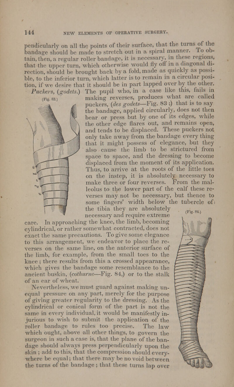 (Fig. 83.) pendicularly on all the points of their surface, that the turns of the bandage should be made to stretch out in a spiral manner. To ob- tain, then, a regular roller bandage, it is necessary, in these regions, that the upper turn, which otherwise would fly off in a diagonal di- rection, should be brought back by a fold, made as quickly as possi- ble, to the inferior turn, which latter is to remain in a circular posi- tion, if we desire that it should be in part lapped over by the other. Puckers, {godets.) The pupil who, in a case like this, fails in making reverses, produces what are called puckers, (des godets—Fig. 83 ;) that is to say the bandage, applied circularly, does not then bear or press but by one of its edges, while the other edge flares out, and remains open, and tends to be displaced. These puckers not only take away from the bandage every thing that it might possess of elegance, but they also cause the limb to be strictured from space to space, and the dressing to become displaced from the moment of its application. Thus, to arrive at the roots of the little toes on the instep, it is absolutely necessary to make three or four reverses. From the mal- leolus to the lower part of the calf these re- verses may not be necessary, but thence to some fingers' width below the tubercle ofi the tibia they are absolutely necessary and require extreme care. In approaching the knee, the limb, becoming cylindrical, or rather somewhat contracted, does not exact the same precautions. To give some elegance to this arrangement, we endeavor to place the re- verses on the same line, on the anterior surface of the limb, for example, from the small toes to the knee; there results from this a crossed appearance, which gives the bandage some resemblance to the ancient buskin, (coiliurne—Fig. 84,) or to the stalk of an ear of wheat. Nevertheless, we must guard against making un- equal pressure on any part, merely for the purpose of giving greater regularity to the dressing. As the cylindrical or conical form of the part is not the same in every individual, it would be manifestly in- jurious to wish to submit the application of the roller bandage to rules too precise. The law which ought, above all other things, to govern the surgeon in such a case is, that the plane of the ban- dage should always press perpendicularly upon the skin ; add to this, that the compression should every- where be equal; that there may be no void between the turns of the bandage ; that these turns lap over (Fig. 84.)