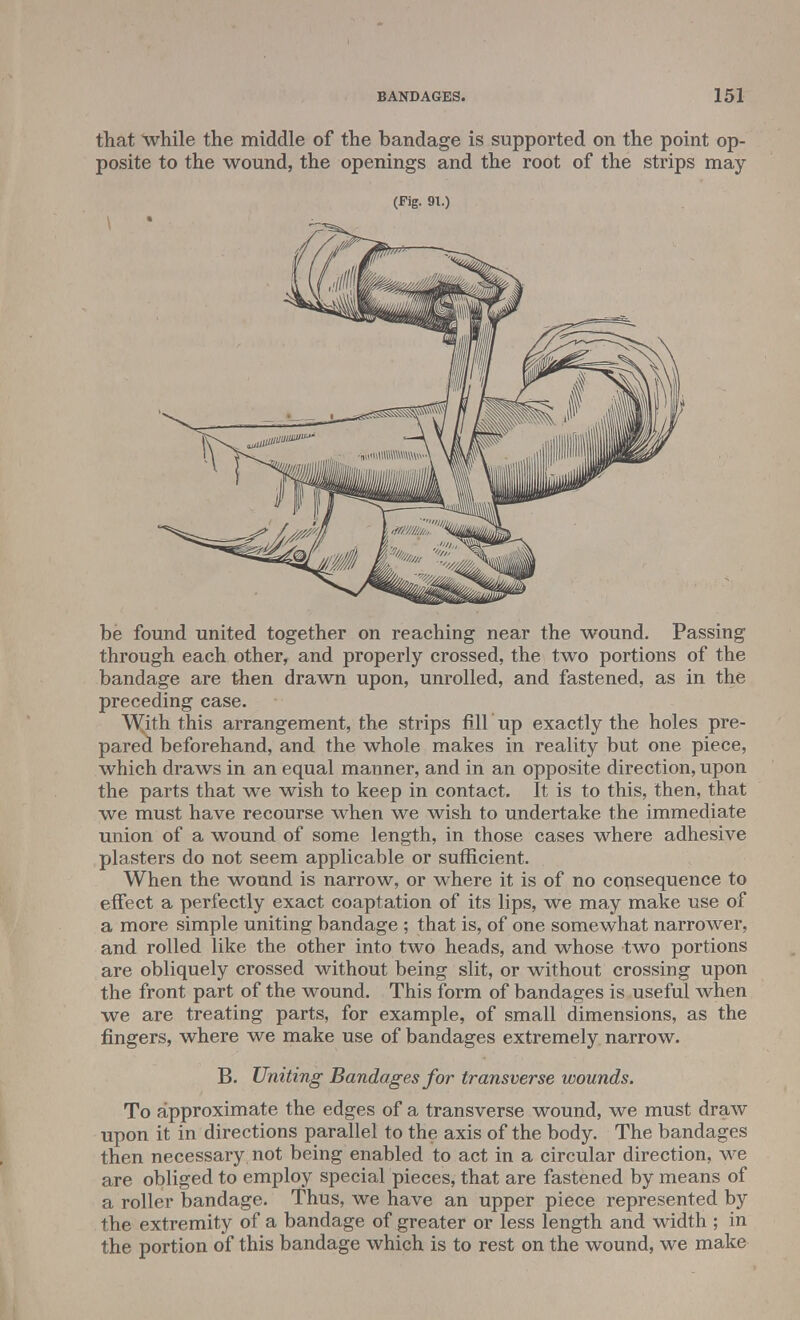 that while the middle of the bandage is supported on the point op- posite to the wound, the openings and the root of the strips may (Fig. 91.) be found united together on reaching near the wound. Passing through each other, and properly crossed, the two portions of the bandage are then drawn upon, unrolled, and fastened, as in the preceding case. With, this arrangement, the strips fill up exactly the holes pre- pared beforehand, and the whole makes in reality but one piece, which draws in an equal manner, and in an opposite direction, upon the parts that we wish to keep in contact. It is to this, then, that we must have recourse when we wish to undertake the immediate union of a wound of some length, in those cases where adhesive plasters do not seem applicable or sufficient. When the wound is narrow, or where it is of no consequence to effect a perfectly exact coaptation of its lips, we may make use of a more simple uniting bandage ; that is, of one somewhat narrower, and rolled like the other into two heads, and whose two portions are obliquely crossed without being slit, or without crossing upon the front part of the wound. This form of bandages is useful when we are treating parts, for example, of small dimensions, as the fingers, where we make use of bandages extremely narrow. B. Uniting Bandages for transverse wounds. To approximate the edges of a transverse wound, we must draw upon it in directions parallel to the axis of the body. The bandages then necessary not being enabled to act in a circular direction, we are obliged to employ special pieces, that are fastened by means of a roller bandage. Thus, we have an upper piece represented by the extremity of a bandage of greater or less length and width ; in the portion of this bandage which is to rest on the wound, we make