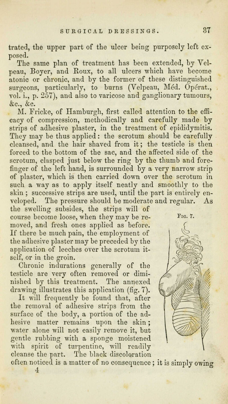 trated, the upper part of the ulcer being purposely left ex- posed. The same plan of treatment has been extended, by Vel- peau, Boyer, and Roux, to all ulcers which have become atonic or chronic, and by the former of these distinguished surgeons, particularly, to burns (Velpeau, He'd. Ope'rat., vol. i., p. 257), and also to varicose and ganglionary tumours, &c, &c. M. Fricke, of Hamburgh, first called attention to the effi- cacy of compression, methodically and carefully made by strips of adhesive plaster, in the treatment of epididymitis. They may be thus applied: the scrotum should be carefully cleansed, and the hair shaved from it; the testicle is then forced to the bottom of the sac, and the affected side of the scrotum, clasped just below the ring by the thumb and fore- finger of the left hand, is surrounded by a very narrow strip of plaster, which is then carried down over the scrotum in such a way as to apply itself neatly and smoothly to the skin; successive strips are used, until the part is entirely en- veloped. The pressure should be moderate and regular. As the swelling subsides, the strips will of course become loose, when they may be re- moved, and fresh ones applied as before. If there be much pain, the employment of the adhesive plaster may be preceded by the application of leeches over the scrotum it- self, or in the groin. Chronic indurations generally of the testicle are very often removed or dimi- nished by this treatment. The annexed drawing illustrates this application (fig. 7). It will frequently be found that, after the removal of adhesive strips from the surface of the body, a portion of the ad- hesive matter remains upon the skin; water alone will not easily remove it, but gentle rubbing with a sponge moistened with spirit of turpentine, will readily cleanse the part. The black discoloration often noticed is a matter of no consequence ; it is simply owing 4 Fig. 7.