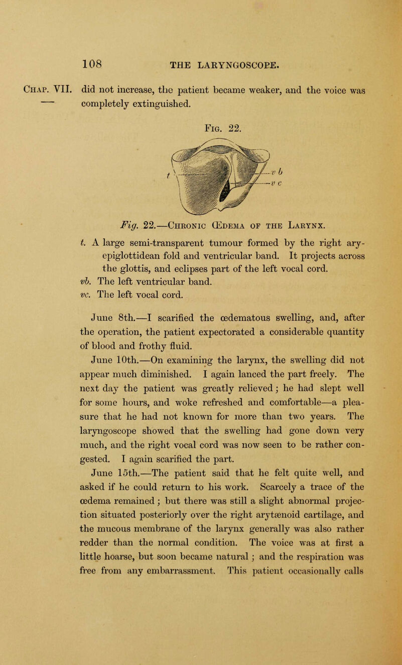 Chap. VII. did not increase, the patient became weaker, and the voice was completely extinguished. Fig. 22. Fig. 22.—Chronic (Edema of the Larynx. t. A large semi-transparent tumour formed by the right ary- epiglottidean fold and ventricular band. It projects across the glottis, and eclipses part of the left vocal cord. vb. The left ventricular band. vc. The left vocal cord. June 8th.—I scarified the oedematous swelling, and, after the operation, the patient expectorated a considerable quantity of blood and frothy fluid. June 10th.—On examining the larynx, the swelling did not appear much diminished. I again lanced the part freely. The next day the patient was greatly relieved; he had slept well for some hours, and woke refreshed and comfortable—a plea- sure that he had not known for more than two years. The laryngoscope showed that the swelling had gone down very much, and the right vocal cord was now seen to be rather con- gested. I again scarified the part. June 15th.—The patient said that he felt quite well, and asked if he could return to his work. Scarcely a trace of the oedema remained ; but there was still a slight abnormal projec- tion situated posteriorly over the right arytaenoid cartilage, and the mucous membrane of the larynx generally was also rather redder than the normal condition. The voice was at first a little hoarse, but soon became natural; and the respiration was free from any embarrassment. This patient occasionally calls