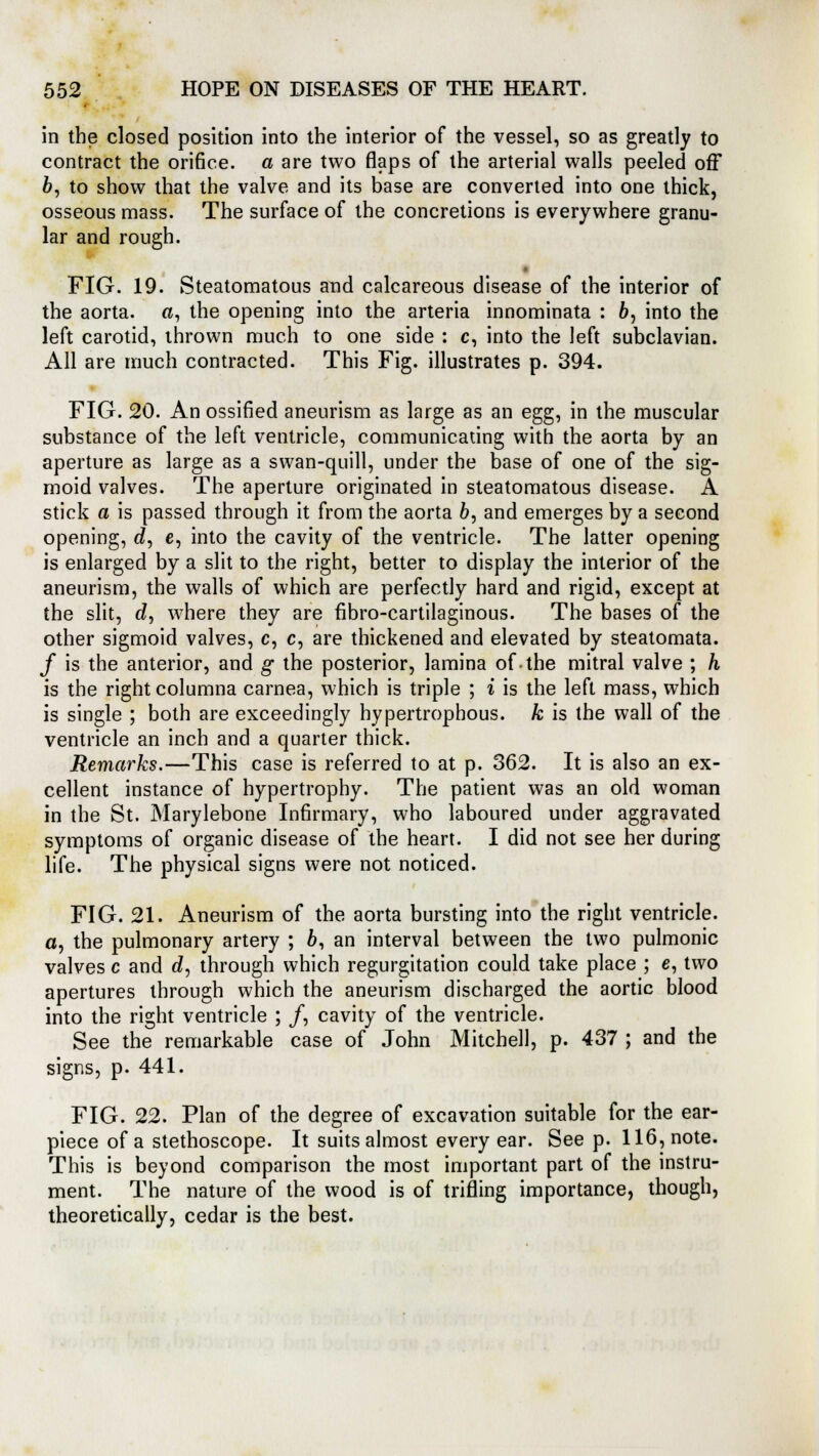 in the closed position into the interior of the vessel, so as greatly to contract the orifice, a are two flaps of the arterial walls peeled off 6, to show that the valve and its base are converted into one thick, osseous mass. The surface of the concretions is everywhere granu- lar and rough. . FIG. 19. Steatomatous and calcareous disease of the interior of the aorta, a, the opening into the arteria innominata : 6, into the left carotid, thrown much to one side : c, into the left subclavian. All are much contracted. This Fig. illustrates p. 394. FIG. 20. An ossified aneurism as large as an egg, in the muscular substance of the left ventricle, communicating with the aorta by an aperture as large as a swan-quill, under the base of one of the sig- moid valves. The aperture originated in steatomatous disease. A stick a is passed through it from the aorta 6, and emerges by a second opening, c/, e, into the cavity of the ventricle. The latter opening is enlarged by a slit to the right, better to display the interior of the aneurism, the walls of which are perfectly hard and rigid, except at the slit, c?, where they are fibro-cartilaginous. The bases of the other sigmoid valves, c, c, are thickened and elevated by steatomata. / is the anterior, and g the posterior, lamina of the mitral valve ; h is the right columna carnea, which is triple ; i is the left mass, which is single ; both are exceedingly hypertrophous. k is the wall of the ventricle an inch and a quarter thick. Remarks.—This case is referred to at p. 362. It is also an ex- cellent instance of hypertrophy. The patient was an old woman in the St. Marylebone Infirmary, who laboured under aggravated symptoms of organic disease of the heart. I did not see her during life. The physical signs were not noticed. FIG. 21. Aneurism of the aorta bursting into the right ventricle, a, the pulmonary artery ; 6, an interval between the two pulmonic valves c and d, through which regurgitation could take place ; e, two apertures through which the aneurism discharged the aortic blood into the right ventricle ; /, cavity of the ventricle. See the remarkable case of John Mitchell, p. 437 ; and the signs, p. 441. FIG. 22. Plan of the degree of excavation suitable for the ear- piece of a stethoscope. It suits almost every ear. See p. 116, note. This is beyond comparison the most important part of the instru- ment. The nature of the wood is of trifling importance, though, theoretically, cedar is the best.