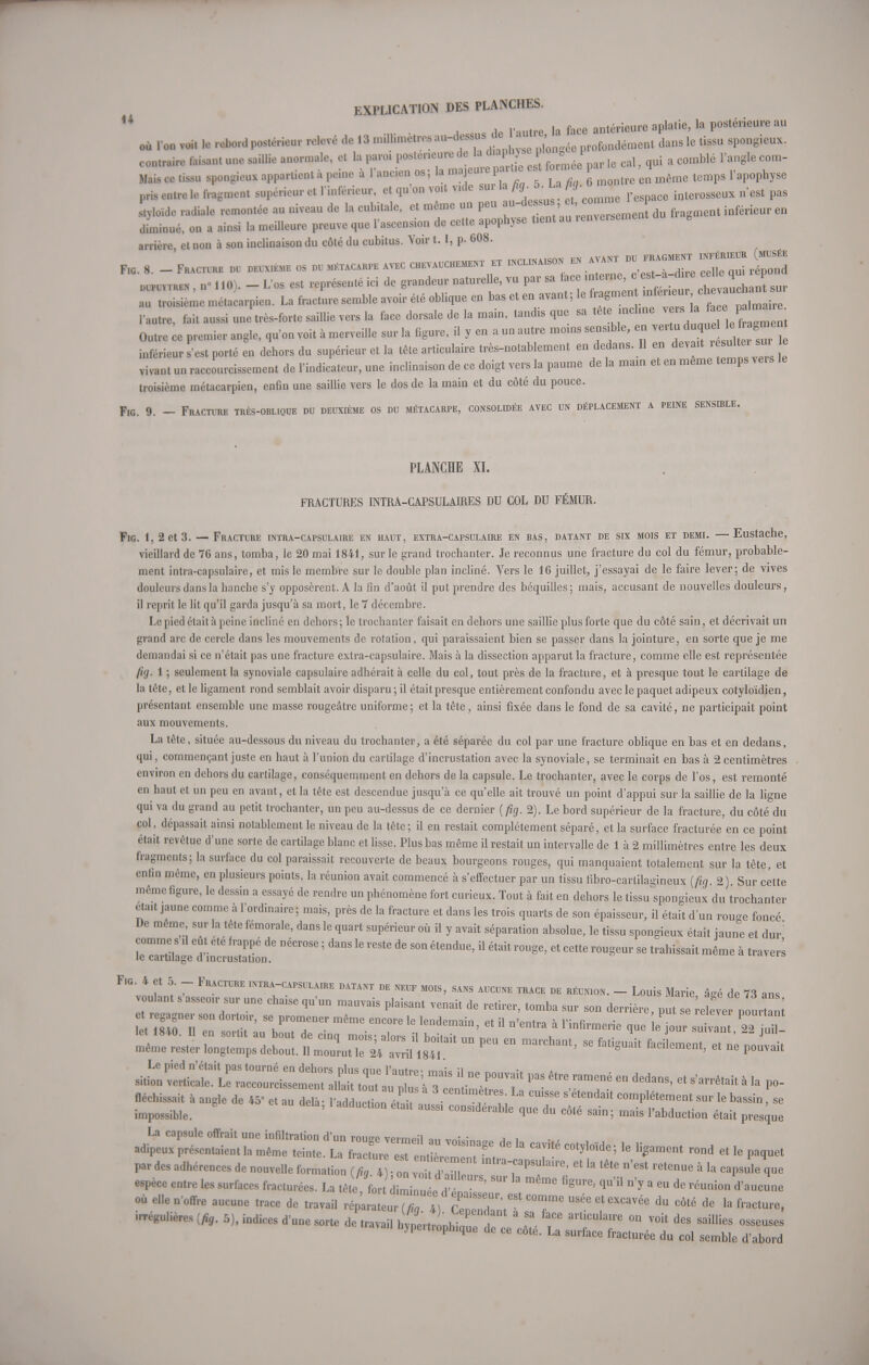 i f, ce antérieure aplatie, la postérieure au où l'on voit le rebord postérieur relevé de 13 profondément dans le tissu spongieux, contraire faisan, une saillie anormale, et la paroi postérieure de la d.apI js plo«gI . e cQm_ Mais ce tissu spongieux appartient à peine à l'ancien os ; la majeure par»* est fmmee a^ , q ^ ^ pris entre le fraient supérieur et l'inférieur, et qu on voit vule su. I /, • 5 • / 9. faftwl» n'est pas Solde radiale remontée au niveau de la cubitale, et même un peu »4>M,J du f t inférieUr en diminué, on a ainsi la meilleure preuve que l'ascension de eelte apophyse t.ent au .enveisement arrière el non à son inclinaison du côté du cubitus. Voir t. I, p. 608. F,C. 8. - FRACTURE . DEUX.EME OS DU MÉTACARPE AVEC CHEVAUCHEMENT ET INCLINAISON *« = », « JjJ ^ dupuytren „• 110). - L'os est représenté ici de grandeur naturelle, vu par sa lace .atome, c est-a d.re ceUe^qui p toLème métacarpien. La fracture semble avoir été oblique en bas et en avant; le l'autre, fait aussi une très-forte sai.lie vers la face dorsale de la main, tandis que sa tête mchne v rs, 1-.hce p Outre ce premier angle, qu'on voit à merveille sur la figure, il y en a un autre moms sensible, en vertu d quele,men inférieurs est porté en dehors du supérieur et la tête articulaire très-notablement en dedans. Il en devait r sultei sur le vivant un raccourcissement de l'indicateur, une inclinaison de ce doigt vers la paume de la main et en même temps veis troisième métacarpien, enfin une saillie vers le dos de la main et du côté du pouce. Fig. 9. — Fracture très-oblique du deuxième os du métacarpe, consolidée avec un déplacement a peine sensible. PLANCHE XI. FRACTURES INTRA-CAPSULAIRES DU COL DU FÉMUR. Fig. 1, 2 et 3. — Fracture intra-capsulaire en haut, extra-capsulaire en bas, datant de six mois et demi. — Eustache, vieillard de 76 ans, tomba, le 20 mai 1841, sur le grand trochanler. Je reconnus une fracture du col du fémur, probable- ment intra-capsulaire, et mis le membre sur le double plan incliné. Vers le 16 juillet, j'essayai de le faire lever; de vives douleurs dans la hanche s'y opposèrent. A la fin d'août il put prendre des béquilles ; mais, accusant de nouvelles douleurs, il reprit le lit qu'il garda jusqu'à sa mort, le 7 décembre. Le pied était à peine incliné en dehors; le trochanter faisait en dehors une saillie plus forte que du côté sain, et décrivait un grand arc de cercle dans les mouvements de rotation, qui paraissaient bien se passer dans la jointure, en sorte que je me demandai si ce n'était pas une fracture extra-capsulaire. Mais à la dissection apparut la fracture, comme elle est représentée fig. 1 ; seulement la synoviale capsulaire adhérait à celle du col, tout près de la fracture, et à presque tout le cartilage de la téte, et le ligament rond semblait avoir disparu; il était presque entièrement confondu avec le paquet adipeux cotyloïdien, présentant ensemble une masse rougeâtre uniforme; et la tète, ainsi fixée dans le fond de sa cavité, ne participait point aux monvfimfinfs. a iiiuuvçiuuuia. La tête, située au-dessous du niveau du trochanter, a été séparée du col par une fracture oblique en bas et en dedans, qui, commençant juste en haut à l'union du cartilage d'incrustation avec la synoviale, se terminait en bas à 2 centimètres environ en dehors du cartilage, conséquemment en dehors de la capsule. Le trochanter, avec le corps de l'os, est remonté en haut et un peu en avant, et la tête est descendue jusqu'à ce qu'elle ait trouvé un point d'appui sur la saillie de la ligne qui va du grand au petit trochanter, un peu au-dessus de ce dernier (fig. 2). Le bord supérieur de la fracture, du côté du col, dépassait ainsi notablement le niveau de la tête ; il en restait complètement séparé, et la surface fracturée en ce point était revêtue d'une sorte de cartilage blanc et lisse. Plus bas même il restait un intervalle de 1 à 2 millimètres entre les deux fragments; la surface du col paraissait recouverte de beaux bourgeons rouges, qui manquaient totalement sur la tête, et enfin même, en plusieurs points, la réunion avait commencé à s'effectuer par un tissu fibro-cartilagineux (fig. 2). Sur cette même figure, le dessin a essayé de rendre un phénomène fort curieux. Tout à fait en dehors le tissu spongieux du trochanter était jaune comme à l'ordinaire; mais, près de la fracture et dans les trois quarts de son épaisseur, il était d'un rouge foncé De même sur la tête fémorale, dans le quart supérieur où il y avait séparation absolue, le tissu spongieux était jaune et dur' F,g. 4 et 5. - Fracture intra-c.vpsulaire datant de neuf mois, sans aucune trace de réunion. - Louis Marie âgé de 73 ans voulant s asseo* sur une chaise qu'un mauvais plaisant venait de retirer, tomba sur son derrière, put 2eZÎ 2 i t regagner son dortoir, se promener même encore le lendemain, et il n'entra à l'infirmerie que e jour suivan ï2 !TrU^dr,ÎZuU~ ^a* - - « —' - -Lent, e™ sit-z:s^ fléchissait à angle de 45» e a del ' fl^^-^T^  S'étendait complètement sur le bassin 'se impossible. ' Ct'0n e'a,t 3USS1 conside^e que du côté sain ; mais l'abduction était presque La capsule offrait une infiltration d'un rouée vermpil n„ a i adipeux p^cune», I. méme .cime. U S-TT T. T C<ïl0,dC'16 >d » le «•* pa, de» adhoreoees de nouvelle formation ,Tl . Z Z da7 T^ ^  ^ Mm<> à '» V**