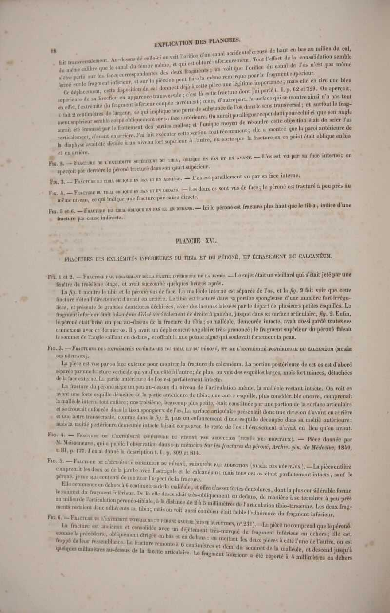 . ., -n p d>un Canal accidentel creusé de haut en bas au milieu du cal, fait transversalement. Au-dessus de celle-ci on voit 1 01lff j ^ nf6l,ieurement. Tout l'effort de la consolidation semble r;aHbre que .e canal du fémur ^^J^ 1 voit que l'orifice du canal de l'os n'est pas même ^poTte sur les faces correspondantes des **«gj™tae remarque pour le fragmfit prieur, fermé sur le fragment inférieur, et sur la ^^T^l pièce une légitime importance ; ma, elle en tire une bien Ce déplacement, cette disposition du cal donnen dqa .c ^ ^ ^ % ^ p ^ ^ Qn supérieure de sa direction en apparence transversale c es ^ ^ ^ ^ ^ Q a pag ^ en effet, l'extrémité du fragment inférieur coupée carrément n ^ ^ ^ ^ ,e seng transversal, et surtout le frag- à fait 2 centimètres de largeur, ce qui ^^^.^ 0n aurait pu alléguer cependant pour celui-ci que son angle llient supérieur semble coupé obliquement sur sa face amené . ^ ^ objection é{ait de gcier Fos aurai» été émoussé par le frottement des parties mol es, tl» . e„e a montre que ia paroi antérieure de verticalement, d'avant en arrière. J'ai fait executei cen en ce ^ était oblique enbas la diaphyse avait été divisée à un niveau fort supérieur a 1 autre, en sorte que ™ bas ft fn avant. — L'os est vu par sa face interne; on Fig 2 -Fracture de l'extrême supérieure du tibia, oblique en bas et en aperçoit par derrière le péroné fracturé dans son quart supérieur. F* 3 - Fracture du tibia oblioue en bas et en arrière. - L'os est pareillement vu par sa face interne. F, ' 4 - Fracture du tib,a oblioue « bas et en dedans. - Les deux os sont vus de face ; le péroné est fracturé à peu près au mime niveau, ce qui indique une fracture par cause directe. Fig. 5 et 6. - Fracture du tibia oblique en bas et en dedans. - Ici le péroné est fracturé plus haut que le tibia, indicé d'une fracture par cause indirecte. PLANCHE XVI. FRACTURES DES EXTRÉMITÉS INFÉRIEURES DU TIRIA ET DU PÉRONÉ, ET ÉCRASEMENT DU CALCANÉUM. Fig. 1 et 2. — Fracture par écrasement de la partie inférieure de la jamre. — Le sujet était un vieillard qui s'était jeté par une fenêtre du troisième étage, et avait succombé quelques heures après. La fig. 1 montre le tibia et le péroné vus dé face. La malléole interne est séparée de l'os, et la fig. 2 fait voir que cette fracture s'étend directement d'avant en arrière. Le tibia est fracturé dans sa portion spongieuse d'une manière fort irrégu- lière, et présente de grandes dentelures déchirées, avec des lacunes laissées par le départ de plusieurs petites esquilles. Le fragment inférieur était lui-même divisé verticalement de droite à gauche, jusque dans sa surface articulaire, fig. 2. Enfin, le péroné était brisé un peu au-dessus de la fracture du tibia; sa malléole, demeurée intacte, avait aussi gardé toutes ses connexions avec ce dernier os. Il y avait un déplacement angulaire très-prononcé; le fragment supérieur du péroné faisait le sommet de l'angle saillant en dedans, et offrait là une pointe aiguë qui soulevait fortement la peau. Fig. 3. —Fractures des extrémités inférieures du tibia et du péroné^ et de l'extrémité postérieure du calcaneum (musée des hôpitaux). La pièce est vue par sa face externe pour montrer la fracture du calcanéum. La portion postérieure de cet os est d'abord séparée par une fracture verticale qui va d'un côté à l'autre ; de plus, on voit des esquilles larges, mais fort minces, détachées de la face externe. La partie antérieure de l'os est parfaitement intacte. La fracture du péroné siège un peu au-dessus du niveau de l'articulation même, la malléole restant intacte. On voit en avant une forte esquille détachée de la partie antérieure du tibia ; une autre esquille, plus considérable encore, comprenait la malléole interne tout entière; une troisième, beaucoup plus petite, était constituée par une portion de la surface articulaire et se trouvait enfoncée dans le tissu spongieux de l'os. La surface articulaire présentait donc une division d'avant en arrière et une autre transversale, comme dans la fig. 2, plus un enfoncement d'une esquille découpée dans sa moitié antérieure; mais la moitié postérieure demeurée intacte faisait corps avec le reste de l'os : l'écrasement n'avait eu lieu qu'en avant. FICm4m~ FRACTURE DE l'extremite ™™™™ ™ péroné par abduction (musee des hôpitaux). - Pièce donnée par M. Maisonneuve, qui a publié l'observation dans son mémoire Sur les fractures du péroné, Archiv. gén. de Médecine, 1840, 1.111, p. 177. J en ai donne la description 1.1, p. 809 et 814. FlGcotp7enairs deuDx ÎZ^f**? ™ 7°™' ™EE PAR AMDCTI0N ^ DES hôpitaux).-La pièce entière r0né T mesuZI^ ^  ^ t0US CeS °S étant liment intacts, sauf le perone, je me suis contente de montrer 1 aspect de la fracture. Elle commence en dehors à 6 centimètres delà malléole et nfïW. A>a . i , , Fig. 6 - Fracture de l'extrémité inférieure du péroné gauche (musée dupuytrfn n° 9<m t • « La fracture est ancienne et consolidée avec un déiètementZ, fO-Lapece e comprend que le péroné, comme la précédente, obliquement dirigée enbas et en deda qe du ,raSment inférieur en dehors; elle est, frappé de leur ressemblance. La fracture remonte à 6 ce f V ^ T hs deux Pièces à côté Va™ de l'autre, on est quelques milumètres au-dessus de la facette articulai™ / , * Gt demi du sommet de 1* malléole, et descend jusqu'à