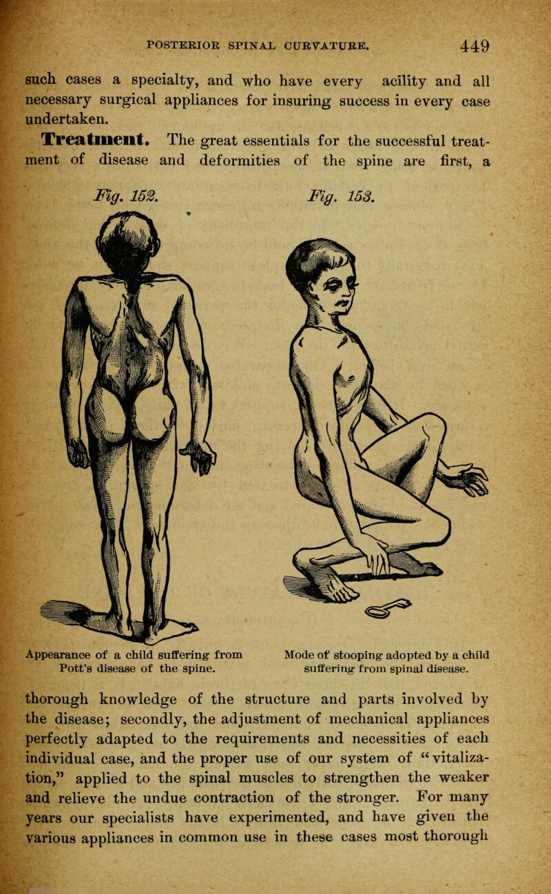 such cases a specialty, and who have every acility and all necessary surgical appliances for insuring success in every case undertaken. Treatment. The great essentials for the successful treat- ment of disease and deformities of the spine are first, a Fig. 152. Fig. 153. Appearance of a child suffering from Pott's disease of the spine. Mode of stooping1 adopted by a child suffering from spinal disease. thorough knowledge of the structure and parts involved by the disease; secondly, the adjustment of mechanical appliances perfectly adapted to the requirements and necessities of each individual case, and the proper use of our system of  vitaliza- tion, applied to the spinal muscles to strengthen the weaker and relieve the undue contraction of the stronger. For many years our specialists have experimented, and have given the various appliances in common use in these cases most thorough