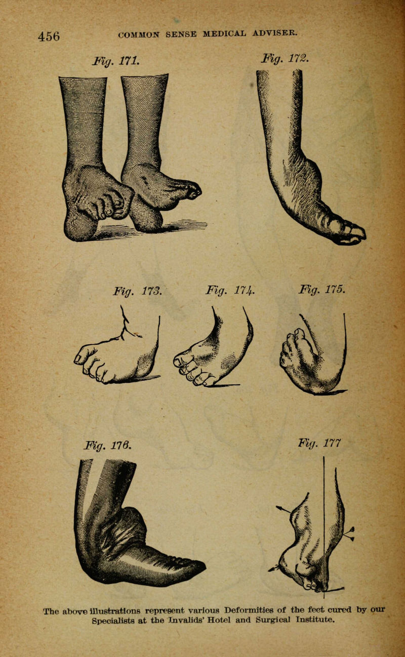 Fig. 171. My- 17& Fig. 173. Fig. 174. Fig. 175. Mg. 176. Fig. 177 The above illustrations represent various Deformities of the feet cured by our Specialists at the Invalids' Hotel and Surgical Institute.