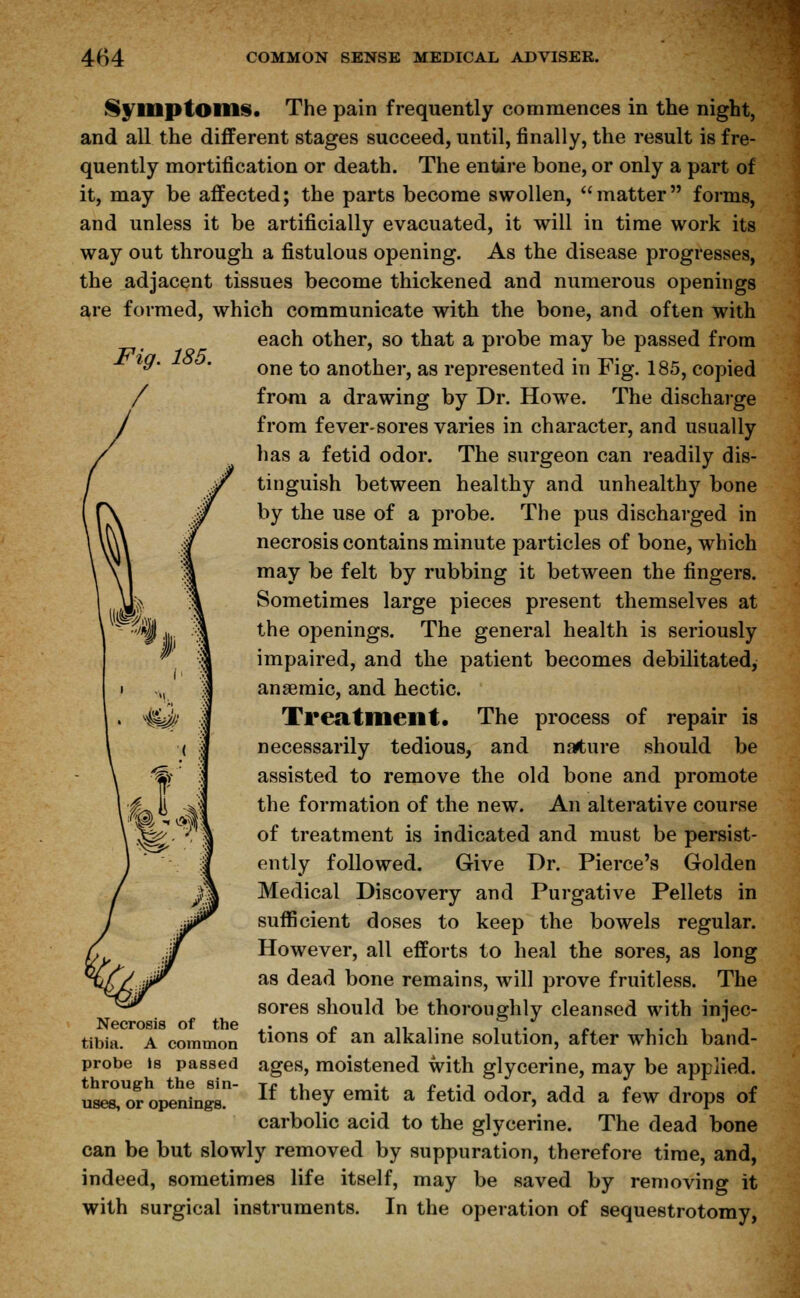 \A Symptoms. The pain frequently commences in the night, and all the different stages succeed, until, finally, the result is fre- quently mortification or death. The entire bone, or only a part of it, may be affected; the parts become swollen, matter forms, and unless it be artificially evacuated, it will in time work its way out through a fistulous opening. As the disease progresses, the adjacent tissues become thickened and numerous openings are formed, which communicate with the bone, and often with each other, so that a probe may be passed from one to another, as represented in Fig. 185, copied from a drawing by Dr. Howe. The discharge from fever-sores varies in character, and usually has a fetid odor. The surgeon can readily dis- tinguish between healthy and unhealthy bone by the use of a probe. The pus discharged in necrosis contains minute particles of bone, which may be felt by rubbing it between the fingers. Sometimes large pieces present themselves at the openings. The general health is seriously impaired, and the patient becomes debilitated, anaemic, and hectic. Treatment. The process of repair is necessarily tedious, and nature should be assisted to remove the old bone and promote the formation of the new. An alterative course of treatment is indicated and must be persist- ently followed. Give Dr. Pierce's Golden Medical Discovery and Purgative Pellets in sufficient doses to keep the bowels regular. However, all efforts to heal the sores, as long as dead bone remains, will prove fruitless. The sores should be thoroughlv cleansed with iniec- Necrosis of the . tibia. A common tions of an alkaline solution, after which band- probe is passed ages, moistened with glycerine, may be applied. uses! or openings *f tlley em*t a ^et^ °&OT, a<ld a few drops of carbolic acid to the glycerine. The dead bone can be but slowly removed by suppuration, therefore time, and, indeed, sometimes life itself, may be saved by removing it with surgical instruments. In the operation of sequestrotomy,