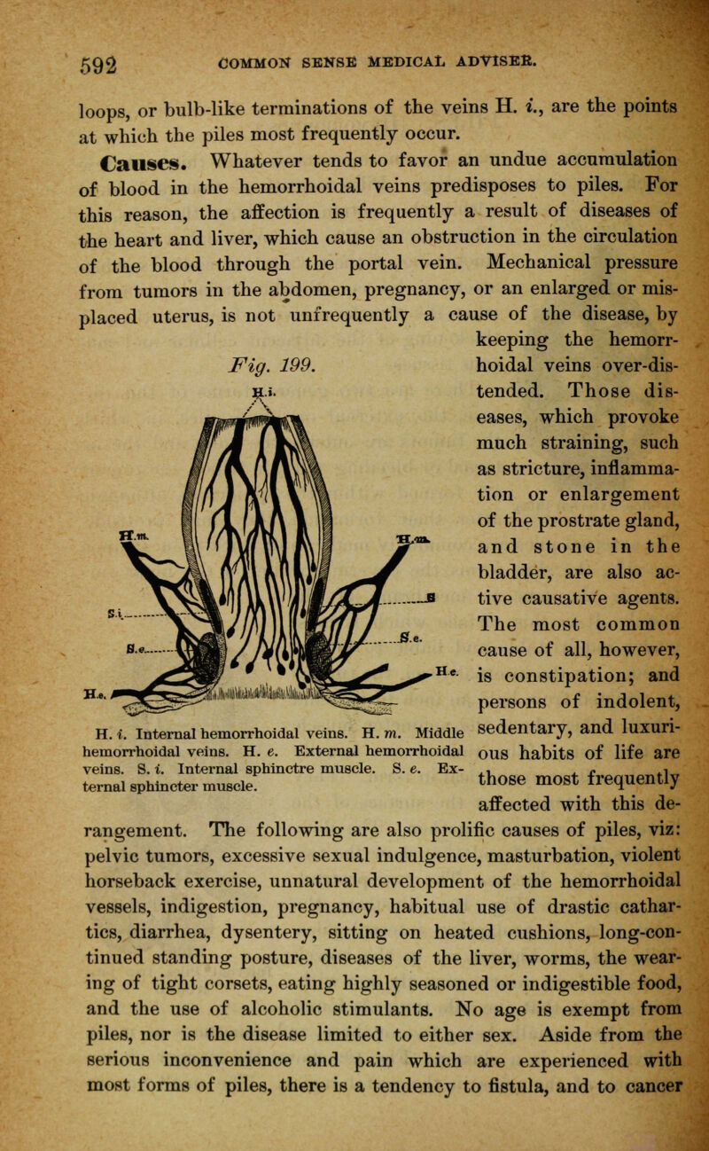 loops, or bulb-like terminations of the veins H. i., are the points at which the piles most frequently occur. Causes. Whatever tends to favor an undue accumulation of blood in the hemorrhoidal veins predisposes to piles. For this reason, the affection is frequently a result of diseases of the heart and liver, which cause an obstruction in the circulation of the blood through the portal vein. Mechanical pressure from tumors in the abdomen, pregnancy, or an enlarged or mis- placed uterus, is not unfrequently a cause of the disease, by keeping the hemorr- Fig. 199. hoidal veins over-dis- tended. Those dis- eases, which provoke much straining, such as stricture, inflamma- tion or enlargement of the prostrate gland, and stone in the bladder, are also ac- tive causative agents. The most common cause of all, however, is constipation; and H He. persons of indolent, H. i. Internal hemorrhoidal veins. H. m. Middle Sedentary, and luxuri- hemorrhoidal veins. H. e. External hemorrhoidal OUS habits of life are veins. S. i. Internal sphinctre muscle. S. e. Ex- ,, , - ., ternal sphincter mnscle. those most frequently affected with this de- rangement. The following are also prolific causes of piles, viz: pelvic tumors, excessive sexual indulgence, masturbation, violent horseback exercise, unnatural development of the hemorrhoidal vessels, indigestion, pregnancy, habitual use of drastic cathar- tics, diarrhea, dysentery, sitting on heated cushions, long-con- tinued standing posture, diseases of the liver, worms, the wear- ing of tight corsets, eating highly seasoned or indigestible food, and the use of alcoholic stimulants. No age is exempt from piles, nor is the disease limited to either sex. Aside from the serious inconvenience and pain which are experienced with most forms of piles, there is a tendency to fistula, and to cancer