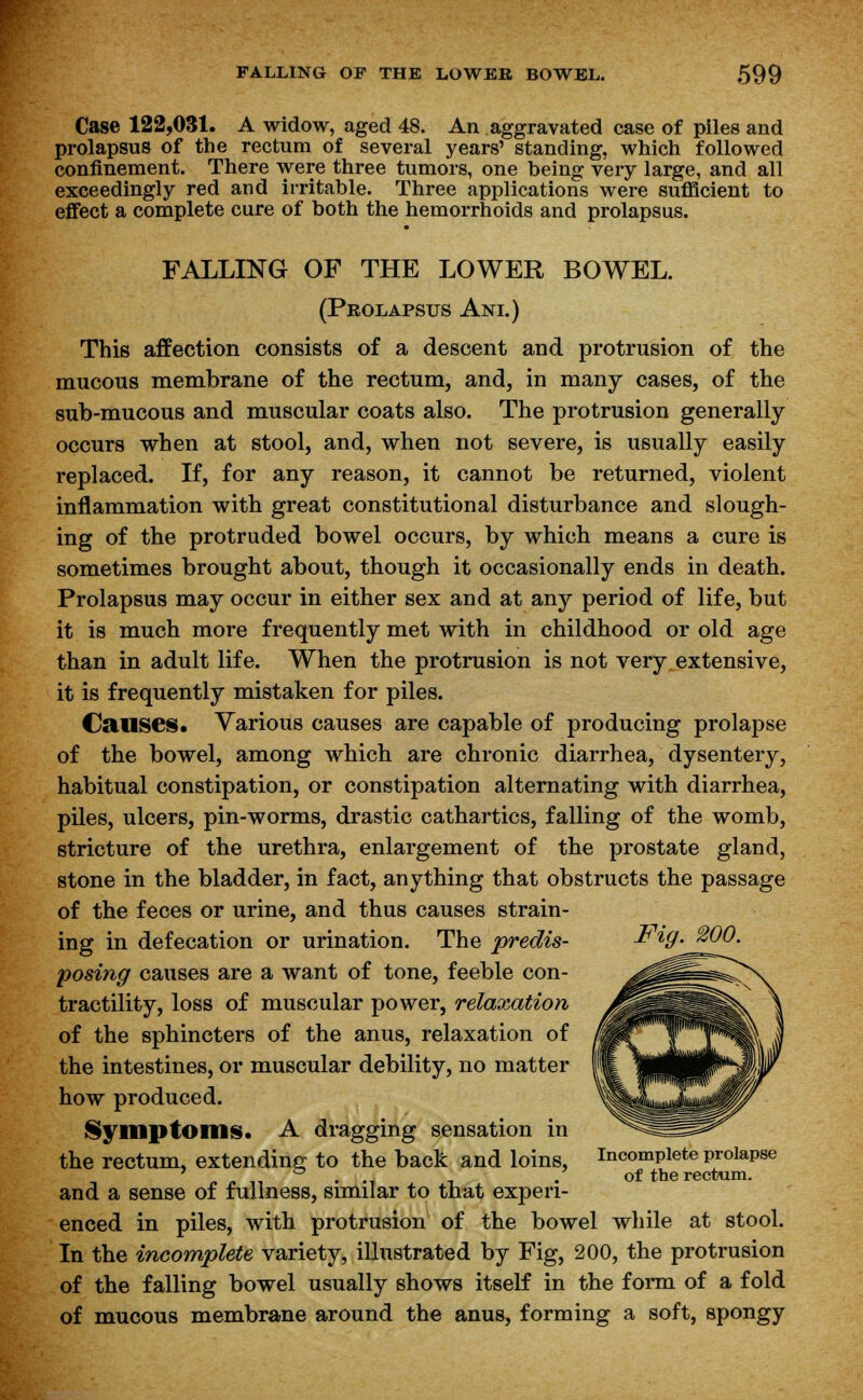 Case 122,031. A widow, aged 48. An aggravated case of piles and prolapsus of the rectum of several years' standing, which followed confinement. There were three tumors, one being very large, and all exceedingly red and irritable. Three applications were sufficient to effect a complete cure of both the hemorrhoids and prolapsus. FALLING OF THE LOWER BOWEL. (Prolapsus Ani.) This affection consists of a descent and protrusion of the mucous membrane of the rectum, and, in many cases, of the sub-mucous and muscular coats also. The protrusion generally occurs when at stool, and, when not severe, is usually easily replaced. If, for any reason, it cannot be returned, violent inflammation with great constitutional disturbance and slough- ing of the protruded bowel occurs, by which means a cure is sometimes brought about, though it occasionally ends in death. Prolapsus may occur in either sex and at any period of life, but it is much more frequently met with in childhood or old age than in adult life. When the protrusion is not very extensive, it is frequently mistaken for piles. Causes. Various causes are capable of producing prolapse of the bowel, among which are chronic diarrhea, dysentery, habitual constipation, or constipation alternating with diarrhea, piles, ulcers, pin-worms, drastic cathartics, falling of the womb, stricture of the urethra, enlargement of the prostate gland, stone in the bladder, in fact, anything that obstructs the passage of the feces or urine, and thus causes strain- ing in defecation or urination. The predis- Fig. WO. posing causes are a want of tone, feeble con- tractility, loss of muscular power, relaxation of the sphincters of the anus, relaxation of the intestines, or muscular debility, no matter how produced. Symptoms. A dragging sensation in the rectum, extending to the back and loins, Incomplete prolapse „-.„.., n . of the rectum. and a sense of fullness, similar to that experi- enced in piles, with protrusion of the bowel while at stool. In the incomplete variety, illustrated by Fig, 200, the protrusion of the falling bowel usually shows itself in the form of a fold of mucous membrane around the anus, forming a soft, spongy