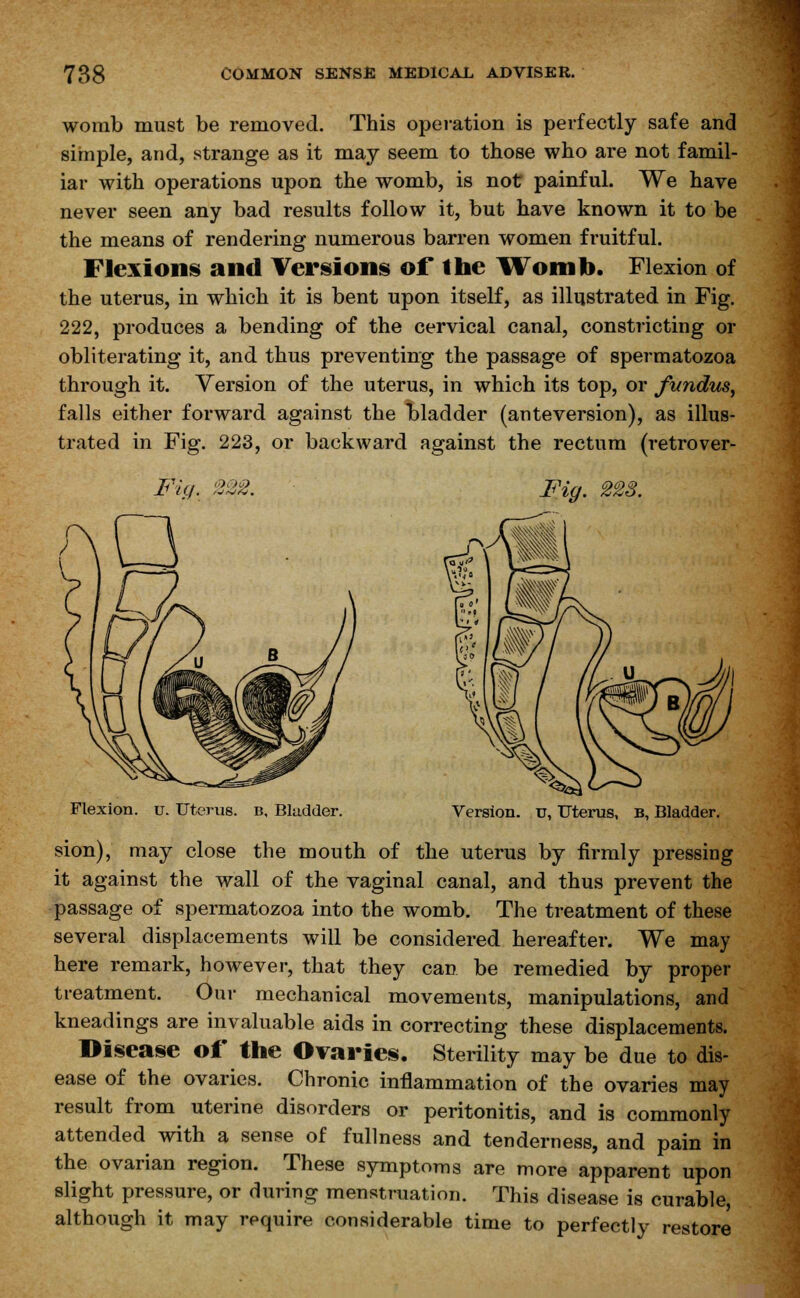 womb must be removed. This operation is perfectly safe and simple, and, strange as it may seem to those who are not famil- iar with operations upon the womb, is not painful. We have never seen any bad results follow it, but have known it to be the means of rendering numerous barren women fruitful. Flexions and Versions of the Womb. Flexion of the uterus, in which it is bent upon itself, as illustrated in Fig. 222, produces a bending of the cervical canal, constricting or obliterating it, and thus preventing the passage of spermatozoa through it. Version of the uterus, in which its top, or fundus, falls either forward against the bladder (anteversion), as illus- trated in Fig. 223, or backward against the rectum (retrover- FU). 2%2. Fig. 2C23. Flexion, u. Uterus, b. Bladder. Version, u, Uterus, B, Bladder. sion), may close the mouth of the uterus by firmly pressing it against the wall of the vaginal canal, and thus prevent the passage of spermatozoa into the womb. The treatment of these several displacements will be considered hereafter. We may here remark, however, that they can be remedied by proper treatment. Our mechanical movements, manipulations, and kneadings are invaluable aids in correcting these displacements. Disease of the Ovaries. Sterility may be due to dis- ease of the ovaries. Chronic inflammation of the ovaries may result from uterine disorders or peritonitis, and is commonly attended with a sense of fullness and tenderness, and pain in the ovarian region. These symptoms are more apparent upon slight pressure, or during menstruation. This disease is curable, although it may require considerable time to perfectly restore