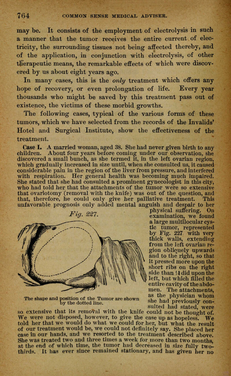 may be. It consists of the employment of electrolysis in such a manner that the tumor receives the entire current of elec- tricity, the surrounding tissues not being affected thereby, and of the application, in conjunction with electrolysis, of other therapeutic means, the remarkable effects of which were discov- ered by us about eight years ago. In many cases, this is the only treatment which offers any hope of recovery, or even prolongation of life. Every year thousands who might be saved by this treatment pass out of existence, the victims of these morbid growths. The following cases, typical of the various forms of these tumors, which we have selected from the records of the Invalids' Hotel and Surgical Institute, show the effectiveness of the treatment. Case I. A married woman, aged 38. She had never given birth to any children. About four years before coming under our observation, she discovered a small bunch, as she termed it, in the left ovarian region, which gradually increased in size until, when she consulted us, it caused considerable pain in the region of the liver from pressure, and interfered with respiration. Her general health was becoming much impaired. She stated that she had consulted a prominent gynecologist in this city, who had told her that the attachments of the tumor were so extensive that ovariotomy (removal with the knife) was out of the question, and that, therefore, he could only give her palliative treatment. This unfavorable prognosis only added mental anguish and despair to her _,. 99 physical suffering. On jr ty. 441. examination, we found a large multilocular cys- tic tumor, represented by Fig. 227 with very thick walls, extending from the left ovarian re- gion obliquely upwards and to the right, so that it pressed more upon the short ribs on the right side than 1 $ did upon the left, but which filled the entire cavity of the abdo- men. The attachments, as the physician whom she had previously con- sulted had stated, were so extensive that its removal with the knife could not be thought of. We were not disposed, however, to give the case up as hopeless. We told her that we would do what we could for her, but what the result of our treatment would be, we could not definitely say. She placed her case in our hands, and we resorted to the treatment described above. She was treated two and three times a week for more than two months, at the end of which time, the tumor had decreased in size fully two- thirds. It has ever since remained stationary, and has given her no The shape and position of the Tumor are shown by the dotted line.