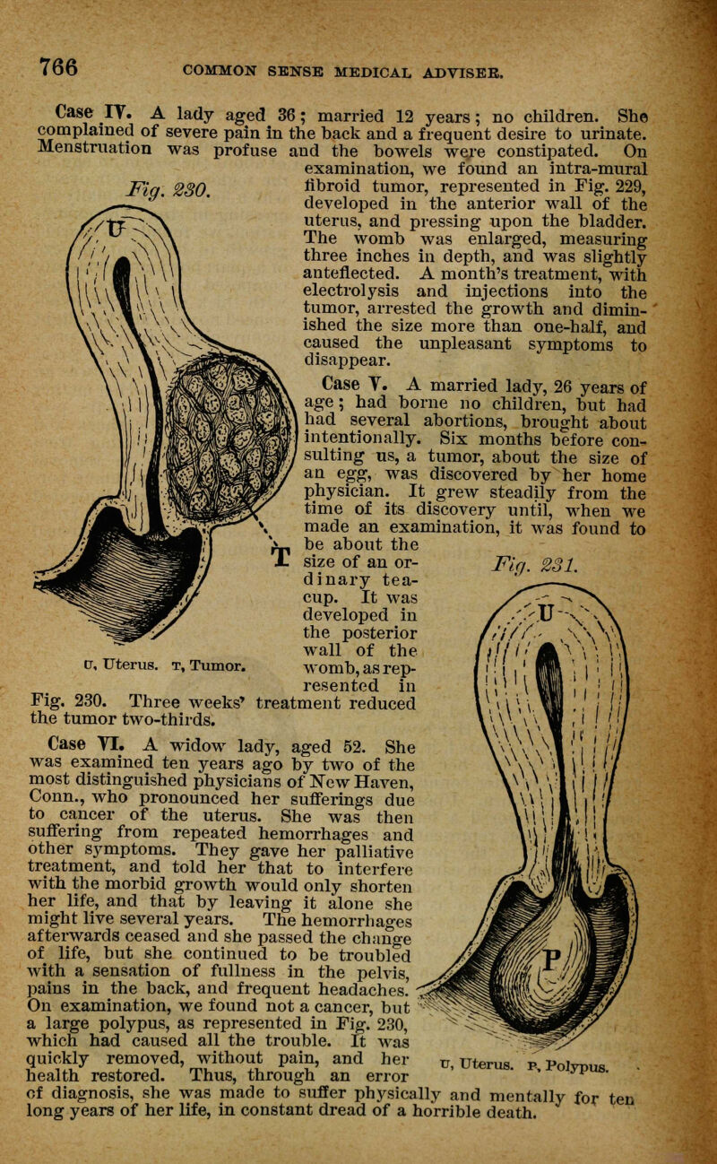 Case IV. A lady aged 36; married 12 years; no children. She complained of severe pain in the back and a frequent desire to urinate. Menstruation was profuse and the bowels were constipated. On examination, we found an intra-mural Fig. 230. fibroid tumor, represented in Fig. 229, developed in the anterior wall of the uterus, and pressing upon the bladder. The womb was enlarged, measuring three inches in depth, and was slightly anteflected. A month's treatment, with electrolysis and injections into the tumor, arrested the growth and dimin- ished the size more than one-half, and caused the unpleasant symptoms to disappear. Case V. A married lady, 26 years of age; had borne no children, but had had several abortions, brought about intentionally. Six months before con- sulting us, a tumor, about the size of an e^g, was discovered by her home physician. It grew steadily from the time of its discovery until, when we made an examination, it was found to be about the size of an or- Fig. 231. dinary tea- cup. It was developed in the posterior wall of the womb, as rep- resented in Fig. 230. Three weeks' treatment reduced the tumor two-thirds. Case VI. A widow lady, aged 52. She was examined ten years ago by two of the most distinguished physicians of New Haven, Conn., who pronounced her sufferings due to cancer of the uterus. She was then suffering from repeated hemorrhages and other symptoms. They gave her palliative treatment, and told her that to interfere with the morbid growth would only shorten her life, and that by leaving it alone she might live several years. The hemorrhages afterwards ceased and she passed the change of life, but she continued to be troubled with a sensation of fullness in the pelvis, pains in the back, and frequent headaches! On examination, we found not a cancer, but a large polypus, as represented in Fig. 230, which had caused all the trouble. It was quickly removed, without pain, and her health restored. Thus, through an error of diagnosis, she was made to suffer physically and mentally for ten long years of her life, in constant dread of a horrible death. tr. Uterus, t, Tumor. tr, Uterus, p, Polypus.