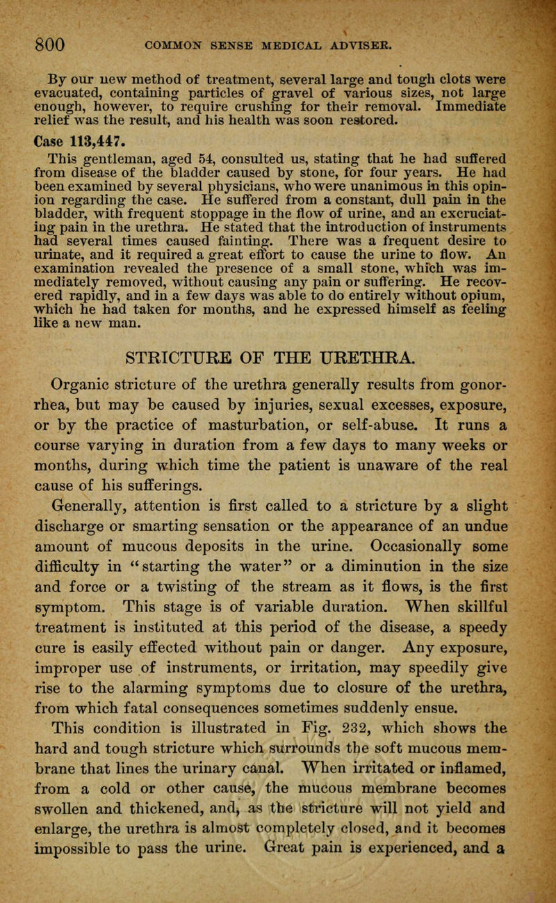 By our new method of treatment, several large and tough clots were evacuated, containing particles of gravel of various sizes, not large enough, however, to require crushing for their removal. Immediate relief was the result, and his health was soon restored. Case 113,4*7. This gentleman, aged 54, consulted us, stating that he had suffered from disease of the bladder caused by stone, for four years. He had been examined by several physicians, who were unanimous in this opin- ion regarding the case. He suffered from a constant, dull pain in the bladder, with frequent stoppage in the flow of urine, and an excruciat- ing pain in the urethra. He stated that the introduction of instruments had several times caused fainting. There was a frequent desire to urinate, and it required a great effort to cause the urine to flow. An examination revealed the presence of a small stone, which was im- mediately removed, without causing any pain or suffering. He recov- ered rapidly, and in a few days was able to do entirely without opium, which he had taken for months, and he expressed himself as feeling like a new man. STRICTURE OF THE URETHRA. Organic stricture of the urethra generally results from gonor- rhea, but may be caused by injuries, sexual excesses, exposure, or by the practice of masturbation, or self-abuse. It runs a course varying in duration from a few days to many weeks or months, during which time the patient is unaware of the real cause of his sufferings. Generally, attention is first called to a stricture by a slight discharge or smarting sensation or the appearance of an undue amount of mucous deposits in the urine. Occasionally some difficulty in starting the water or a diminution in the size and force or a twisting of the stream as it flows, is the first symptom. This stage is of variable duration. When skillful treatment is instituted at this period of the disease, a speedy cure is easily effected without pain or danger. Any exposure, improper use of instruments, or irritation, may speedily give rise to the alarming symptoms due to closure of the urethra, from which fatal consequences sometimes suddenly ensue. This condition is illustrated in Fig. 232, which shows the hard and tough stricture which surrounds the soft mucous mem- brane that lines the urinary canal. When irritated or inflamed, from a cold or other cause, the mucous membrane becomes swollen and thickened, and, as the stricture will not yield and enlarge, the urethra is almost completely closed, and it becomes impossible to pass the urine. Great pain is experienced, and a