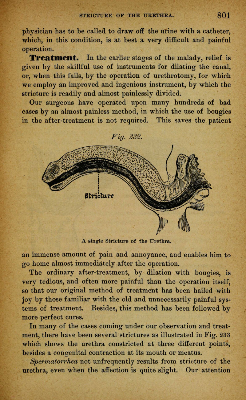 physician has to be called to draw off the urine with a catheter, which, in this condition, is at best a very difficult and painful operation. Treatment. In the earlier stages of the malady, relief is given by the skillful use of instruments for dilating the canal, or, when this fails, by the operation of urethrotomy, for which we employ an improved and ingenious instrument, by which the stricture is readily and almost painlessly divided. Our surgeons have operated upon many hundreds of bad cases by an almost painless method, in which the use of bougies in the after-treatment is not required. This saves the patient Fig. 282. A single Stricture of the Urethra. an immense amount of pain and annoyance, and enables him to go home almost immediately after the operation. The ordinary after-treatment, by dilation with bougies, is very tedious, and often more painful than the operation itself, so that our original method of treatment has been hailed with joy by those familiar with the old and unnecessarily painful sys- tems of treatment. Besides, this method has been followed by more perfect cures. In many of the cases coming under our observation and treat- ment, there have been several strictures as illustrated in Fig. 233 which shows the urethra constricted at three different points, besides a congenital contraction at its mouth or meatus. Spermatorrhea not unfrequently results from stricture of the urethra, even when the affection is quite slight. Our attention