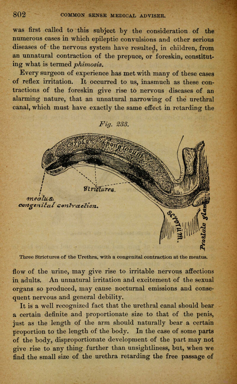 was first called to this subject by the consideration of the numerous cases in which epileptic convulsions and other serious diseases of the nervous system have resulted, in children, from an unnatural contraction of the prepuce, or foreskin, constitut- ing what is termed phimosis. Every surgeon of experience has met with many of these cases of reflex irritation. It occurred to us, inasmuch as these con- tractions of the foreskin give rise to nervous diseases of an alarming nature, that an unnatural narrowing of the urethral canal, which must have exactly the same effect in retarding the Fig. 233. Strictures congenita.! coizbt'deliaiu Three Strictures of the Urethra, with a congenital contraction at the meatus. flow of the urine, may give rise to irritable nervous affections in adults. An unnatural irritation and excitement of the sexual organs so produced, may cause nocturnal emissions and conse- quent nervous and general debility. It is a well recognized fact that the urethral canal should bear a certain definite and proportionate size to that of the penis, just as the length of the arm should naturally bear a certain proportion to the length of the body. In the case of some parts of the body, disproportionate development of the part may not give rise to any thing further than unsightliness, but, when we find the small size of the urethra retarding the free passage of