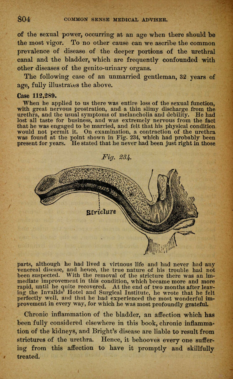 of the sexual power, occurring at an age when there should be the most vigor. To no other cause can we ascribe the common prevalence of disease of the deeper portions of the urethral canal and the bladder, which are frequently confounded with other diseases of the genito-urinary organs. The following case of an unmarried gentleman, 32 years of age, fully illustrates the above. Case 112,289. When he applied to us there was entire loss of the sexual function, with great nervous prostration, and a thin slimy discharge from the urethra, and the usual symptoms of melancholia and debility. He had lost all taste for business, and was extremely nervous from the fact that he was engaged to be married, and felt that his physical condition would not permit it. On examination, a contraction of the urethra was found at the point shown in Fig. 234, which had probably been present for years. He stated that he never had been just right in those Fig. 284. parts, although he had lived a virtuous life and had never hnd any venereal disease, and hence, the true nature of his trouble had not been suspected. With the removal of the stricture there was an im- mediate improvement in this condition, which became more and more rapid, until he quite recovered. At the end of two months after leav- ing the Invalids' Hotel and Surgical Institute, he wrote that he felt perfectly well, and that he had experienced the most wonderful im- provement in every way, for which he was most profoundly grateful Chronic inflammation of the bladder, an affection which has been fully considered elsewhere in this book, chronic inflamma- tion of the kidneys, and Bright's disease are liable to result from strictures of the urethra. Hence, it behooves every one suffer- ing from this affection to have it promptly and skillfully treated.