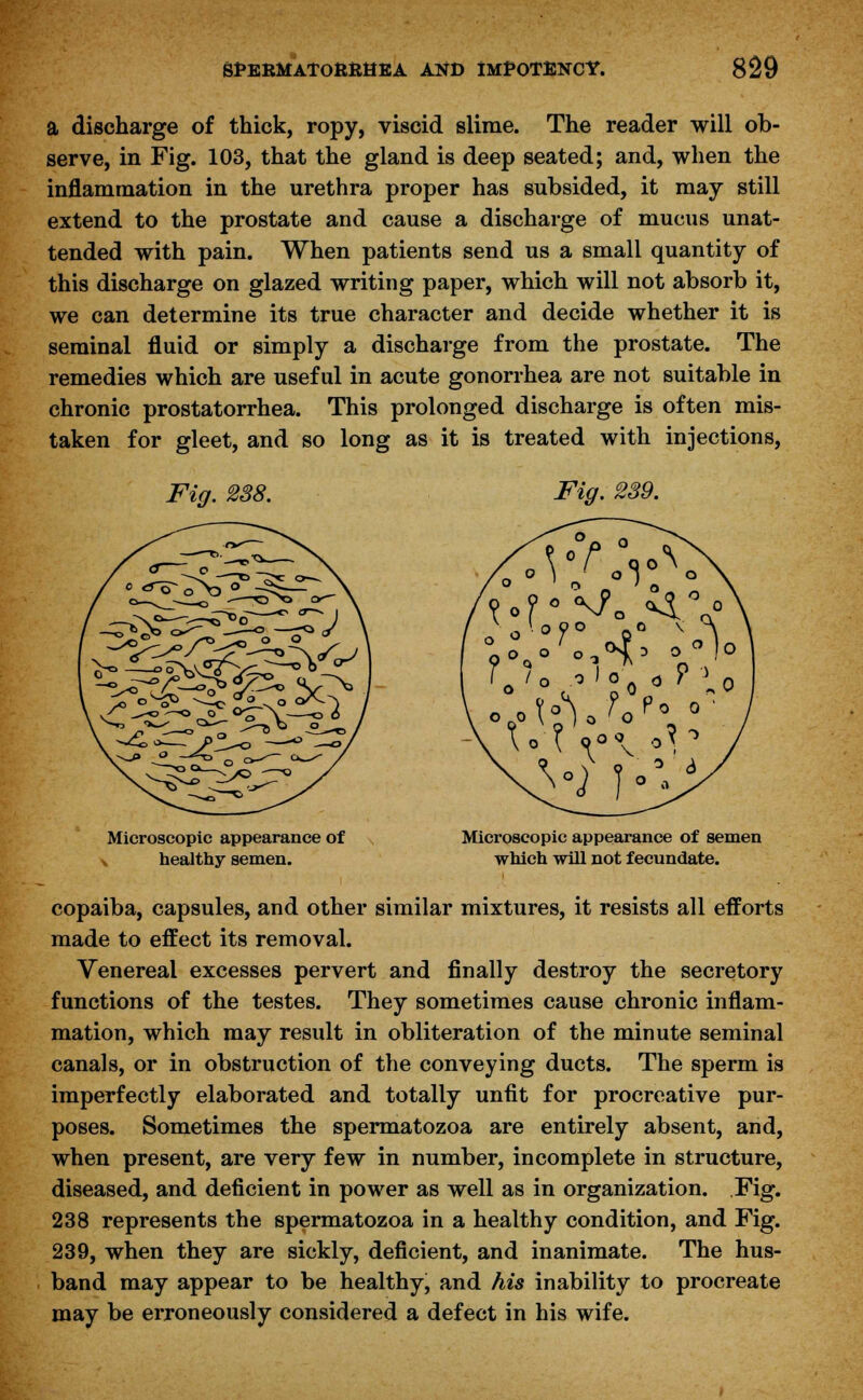 a discharge of thick, ropy, viscid slime. The reader will ob- serve, in Fig. 103, that the gland is deep seated; and, when the inflammation in the urethra proper has subsided, it may still extend to the prostate and cause a discharge of mucus unat- tended with pain. When patients send us a small quantity of this discharge on glazed writing paper, which will not absorb it, we can determine its true character and decide whether it is seminal fluid or simply a discharge from the prostate. The remedies which are useful in acute gonorrhea are not suitable in chronic prostatorrhea. This prolonged discharge is often mis- taken for gleet, and so long as it is treated with injections, Fig. 238. Fig. 239. Microscopic appearance of v healthy semen. Microscopic appearance of semen which will not fecundate. copaiba, capsules, and other similar mixtures, it resists all efforts made to effect its removal. Venereal excesses pervert and finally destroy the secretory functions of the testes. They sometimes cause chronic inflam- mation, which may result in obliteration of the minute seminal canals, or in obstruction of the conveying ducts. The sperm is imperfectly elaborated and totally unfit for procreative pur- poses. Sometimes the spermatozoa are entirely absent, and, when present, are very few in number, incomplete in structure, diseased, and deficient in power as well as in organization. Fig. 238 represents the spermatozoa in a healthy condition, and Fig. 239, when they are sickly, deficient, and inanimate. The hus- band may appear to be healthy, and his inability to procreate may be erroneously considered a defect in his wife.