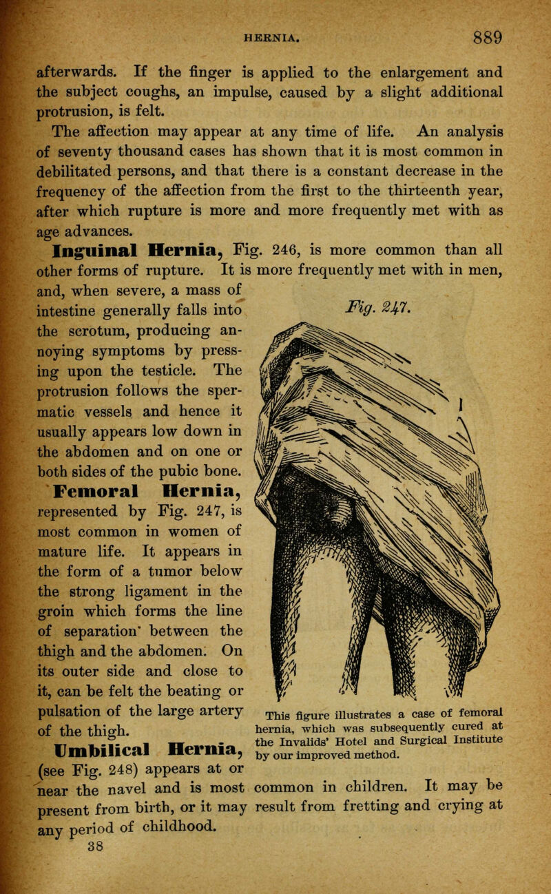 afterwards. If the finger is applied to the enlargement and the subject coughs, an impulse, caused by a slight additional protrusion, is felt. The affection may appear at any time of life. An analysis of seventy thousand cases has shown that it is most common in debilitated persons, and that there is a constant decrease in the frequency of the affection from the first to the thirteenth year, after which rupture is more and more frequently met with as age advances. Inguinal Hernia, Fig. 246, is more common than all other forms of rupture. It is more frequently met with in men, and, when severe, a mass of intestine generally falls into the scrotum, producing an- noying symptoms by press- ing upon the testicle. The protrusion follows the sper- matic vessels and hence it usually appears low down in the abdomen and on one or both sides of the pubic bone. Femoral Hernia, represented by Fig. 247, is most common in women of mature life. It appears in the form of a tumor below the strong ligament in the groin which forms the line of separation* between the thigh and the abdomen. On its outer side and close to it, can be felt the beating or pulsation of the large artery of the thigh. Fig. 21i.1t. Umbilical Hernia, This figure illustrates a case of femoral hernia, which was subsequently cured at the Invalids' Hotel and Surgical Institute by our improved method. (see Fig. 248) appears at or near the navel and is most common in children. It may be present from birth, or it may result from fretting and crying at any period of childhood. 38