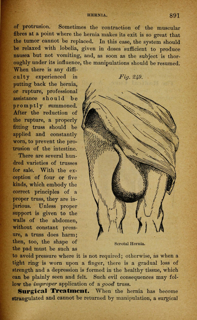 of protrusion. Sometimes the contraction of the muscular fibres at a point where the hernia makes its exit is so great that the tumor cannot be replaced. In this case, the system should be relaxed with lobelia, given in doses sufficient to produce nausea but not vomiting, and, as soon as the subject is thor- oughly under its influence, the manipulations should be resumed. When there is any diffi- culty experienced in Fig. 2^9. - putting back the hernia, / or rupture, professional $/*. assistance should be promptly summoned. After the reduction of the rupture, a properly fitting truss should be applied and constantly worn, to prevent the pro- trusion of the intestine. There are several hun- dred varieties of trusses for sale. With the ex- ception of four or five kinds, which embody the correct principles of a proper truss, they are in- jurious. Unless proper support is given to the walls of the abdomen, without constant press- ure, a truss does harm; then, too, the shape of the pad must be such as to avoid pressure where it is not required; otherwise, as when a tight ring is worn upon a finger, there is a gradual loss of strength and a depression is formed in the healthy tissue, which can be plainly seen and felt. Such evil consequences may fol- low the improper application of a good truss. Surgical Treatment. When the hernia has become strangulated and cannot be returned by manipulation, a surgical Scrotal Hernia.