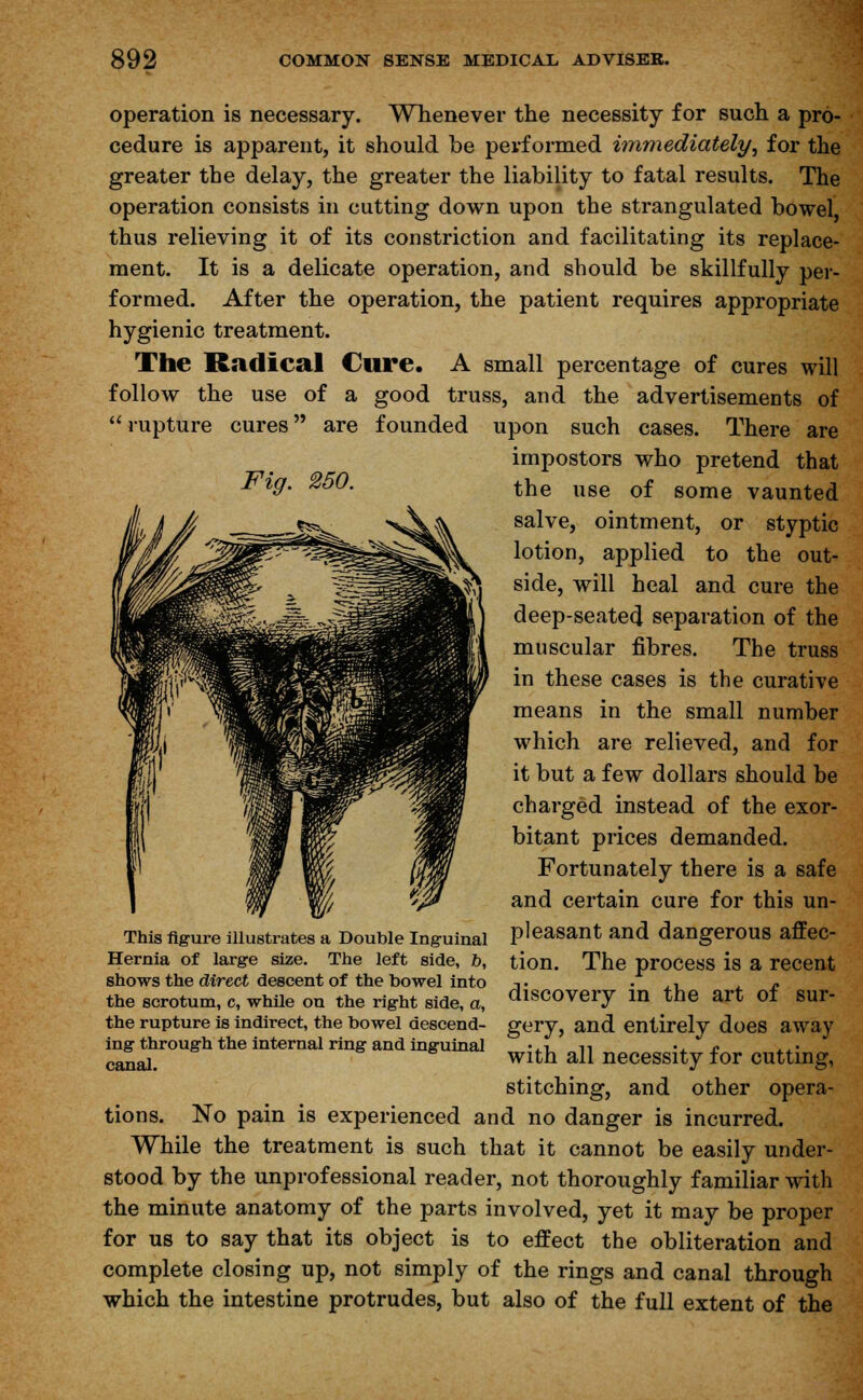 operation is necessary. Whenever the necessity for such a pro- cedure is apparent, it should be performed immediately, for the greater the delay, the greater the liability to fatal results. The operation consists in cutting down upon the strangulated bowel, thus relieving it of its constriction and facilitating its replace- ment. It is a delicate operation, and should be skillfully per- formed. After the operation, the patient requires appropriate hygienic treatment. The Radical Cure. A small percentage of cures will follow the use of a good truss, and the advertisements of  rupture cures are founded upon such cases. There are impostors who pretend that the use of some vaunted salve, ointment, or styptic lotion, applied to the out- side, will heal and cure the deep-seated separation of the muscular fibres. The truss in these cases is the curative means in the small number which are relieved, and for it but a few dollars should be charged instead of the exor- bitant prices demanded. Fortunately there is a safe and certain cure for this un- pleasant and dangerous affec- tion. The process is a recent discovery in the art of sur- gery, and entirely does away with all necessity for cutting, stitching, and other opera- tions. No pain is experienced and no danger is incurred. While the treatment is such that it cannot be easily under- stood by the unprofessional reader, not thoroughly familiar with the minute anatomy of the parts involved, yet it may be proper for us to say that its object is to effect the obliteration and complete closing up, not simply of the rings and canal through which the intestine protrudes, but also of the full extent of the This figure illustrates a Double Inguinal Hernia of large size. The left side, o, shows the direct descent of the bowel into the scrotum, c, while on the right side, a, the rupture is indirect, the bowel descend- ing through the internal ring and inguinal canal.