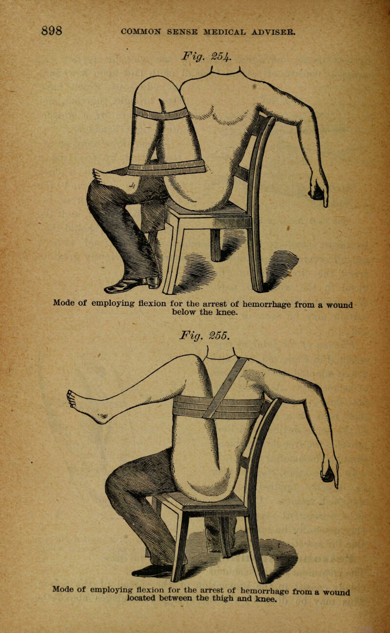 Fig. 25^. Mode of employing flexion for the arrest of hemorrhage from a wound below the knee. Fig. 255. Mode of employing flexion for the arrest of hemorrhage from a wound located between the thigh and knee.