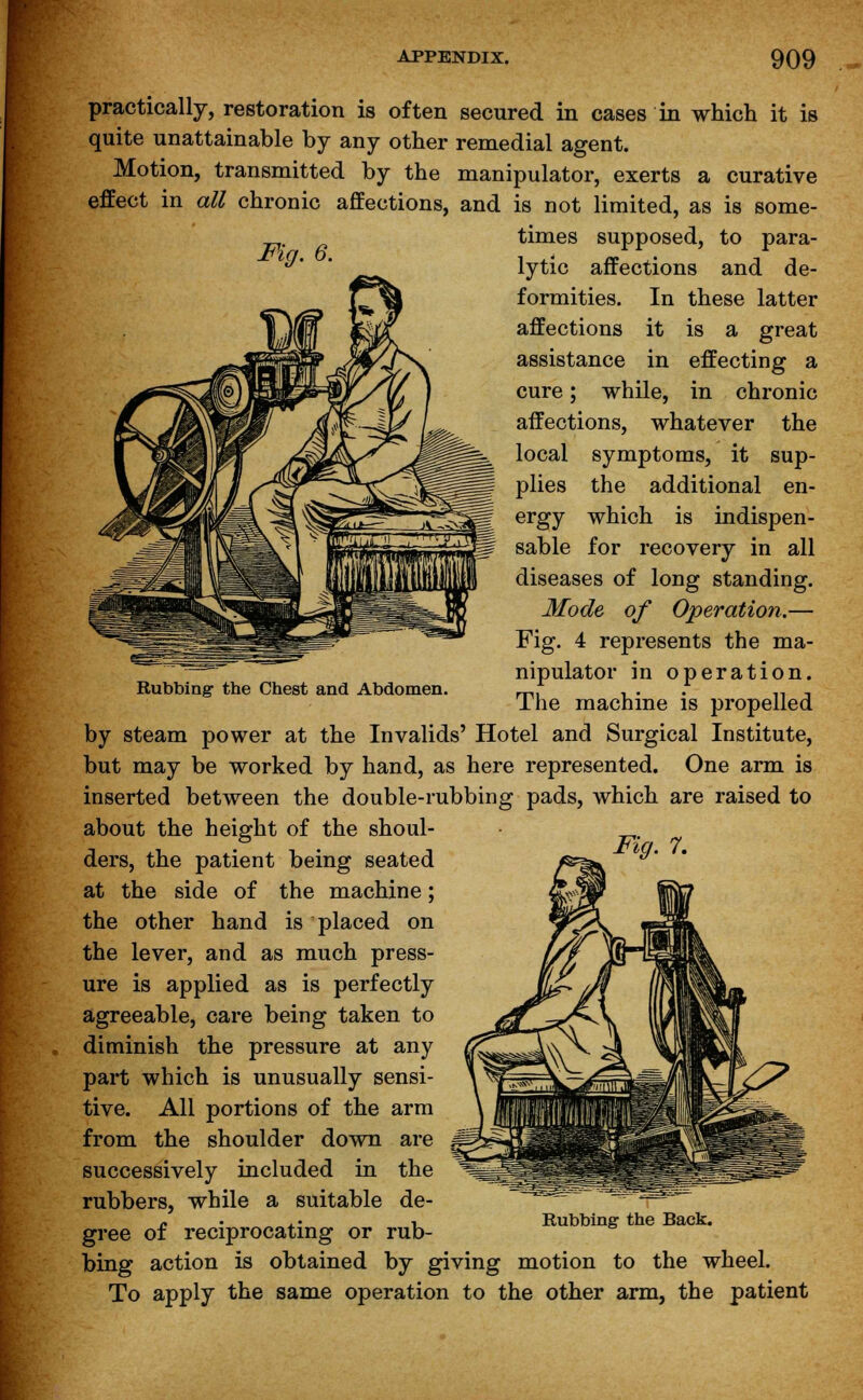 Rubbing the Chest and Abdomen. practically, restoration is often secured in cases in which it is quite unattainable by any other remedial agent. Motion, transmitted by the manipulator, exerts a curative effect in all chronic affections, and is not limited, as is some- times supposed, to para- ' lytic affections and de- formities. In these latter affections it is a great assistance in effecting a cure; while, in chronic affections, whatever the local symptoms, it sup- plies the additional en- ergy which is indispen- sable for recovery in all diseases of long standing. Mode of Operation.— Fig. 4 represents the ma- nipulator in operation. The machine is propelled by steam power at the Invalids' Hotel and Surgical Institute, but may be worked by hand, as here represented. One arm is inserted between the double-rubbing pads, which are raised to about the height of the shoul- • ders, the patient being seated ^ &' at the side of the machine; the other hand is placed on the lever, and as much press- ure is applied as is perfectly agreeable, care being taken to diminish the pressure at any part which is unusually sensi- tive. All portions of the arm from the shoulder down are successively included in the rubbers, while a suitable de- gree of reciprocating or rub- bing action is obtained by giving motion to the wheel. To apply the same operation to the other arm, the patient