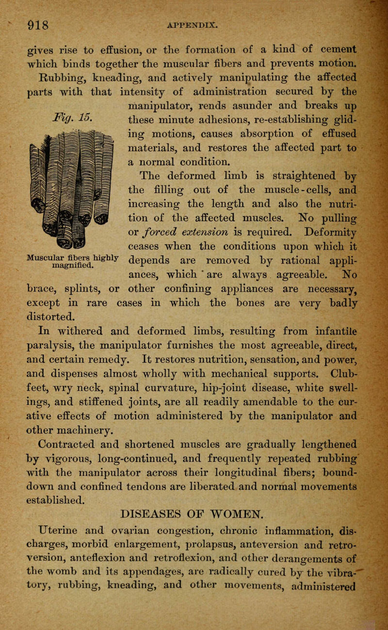 Fig. 15. gives rise to effusion, or the formation of a kind of cement which binds together the muscular fibers and prevents motion. Rubbing, kneading, and actively manipulating the affected parts with that intensity of administration secured by the manipulator, rends asunder and breaks up these minute adhesions, re-establishing glid- ing motions, causes absorption of effused materials, and restores the affected part to a normal condition. The deformed limb is straightened by the filling out of the muscle - cells, and increasing the length and also the nutri- tion of the affected muscles. No pulling or forced extension is required. Deformity ceases when the conditions upon which it Muscu^r^beij highly depends are removed by rational appli- ances, which ' are always agreeable. No brace, splints, or other confining appliances are necessary, except in rare cases in which the bones are very badly distorted. In withered and deformed limbs, resulting from infantile paralysis, the manipulator furnishes the most agreeable, direct, and certain remedy. It restores nutrition, sensation, and power, and dispenses almost wholly with mechanical supports. Club- feet, wry neck, spinal curvature, hip-joint disease, white swell- ings, and stiffened joints, are all readily amendable to the cur- ative effects of motion administered by the manipulator and other machinery. Contracted and shortened muscles are gradually lengthened by vigorous, long-continued, and frequently repeated rubbing with the manipulator across their longitudinal fibers; bound- down and confined tendons are liberated and normal movements established. DISEASES OF WOMEN. Uterine and ovarian congestion, chronic inflammation, dis- charges, morbid enlargement, prolapsus, anteversion and retro- version, anteflexion and retroflexion, and other derangements of the womb and its appendages, are radically cured by the vibra- tory, rubbing, kneading, and other movements, administered