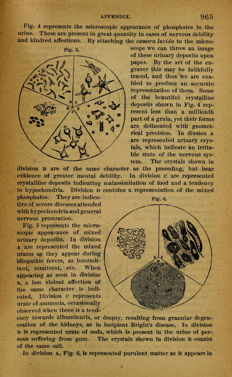 Fig. 4 represents the microscopic appearance of phosphates in the urine. These are present in great quantity in cases of nervous debility and kindred affections. By attaching the camera lucida to the micro- Fig# 5# scope we can throw an image of these urinary deposits upon paper. By the art of the en- graver this may be faithfully traced, and thus we are ena- bled to produce an accurate representation of them. Some of the beautiful crystalline deposits shown in Fig. 4 rep- resent less than a millionth part of a grain, yet their forms are delineated with geomet- rical precision. In divsion A are represented urinary crys- tals, which indicate an irrita- ble state of the nervous sys- tem. The crystals shown in division b are of the same character as the preceding, but bear evidence of greater mental debility. In division c are represented crystalline deposits indicating malassimilation of food and a tendency to hypochondria. Division d contains a representation of the mixed Fig-. 6. phosphates. They are indica- tive of severe diseases attended with hypochondria and general nervous prostration. Fig. 5 represents the micro- scopic appearance of mixed urinary deposits. In division A are represented the mixed urates a$ they appear during idiopathic fevers, as intermit- tent, remittent, etc. When appearing as seen in division b, a less violent affection of the same character is indi- cated. Division c represents urate of ammonia, occasionally observed when there is a tend- ency towards albuminuria, or dropsy, resulting from granular degen- eration of the kidneys, as in incipient Bright's disease. In division d is represented urate of soda, which is present in the urine of per- sons suffering from gout. The crystals shown in division E consist of the same salt. In division a, Fig. 6, is represented purulent matter as it appears in