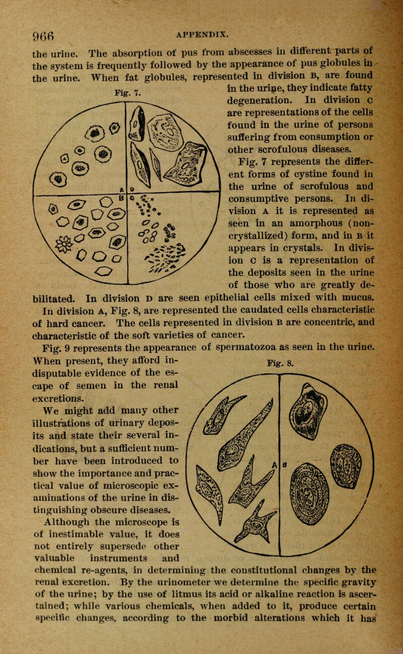 the urine. The absorption of pus from abscesses in different parts of the system is frequently followed by the appearance of pus globules in the urine. When fat globules, represented in division B, are found in the urine, they indicate fatty degeneration. In division c are representations of the cells found in the urine of persons suffering from consumption or other scrofulous diseases. Fig. 7 represents the differ- ent forms of cystine found in the urine of scrofulous and consumptive persons. In di- vision a it is represented as seen in an amorphous (non- crystallized) form, and in b it appears in crystals. In divis- ion c is a representation of the deposits seen in the urine of those who are greatly de- bilitated. In division d are seen epithelial cells mixed with mucus. In division a, Fig. 8, are represented the caudated cells characteristic of hard cancer. The cells represented in division b are concentric, and characteristic of the soft varieties of cancer. Fig. 9 represents the appearance of spermatozoa as seen in the urine. When present, they afford in- ^g 8 disputable evidence of the es- cape of semen in the renal excretions. We might add many other illustrations of urinary depos- its and state their several in- dications, but a sufficient num- ber have been introduced to show the importance and prac- tical value of microscopic ex- aminations of the urine in dis- tinguishing obscure diseases. Although the microscope is of inestimable value, it does not entirely supersede other valuable instruments and chemical re-agents, in determining the constitutional changes by the renal excretion. By the urinometer we determine the specific gravity of the urine; by the use of litmus its acid or alkaline reaction is ascer- tained; while various chemicals, when added to it, produce certain specific changes, according to the morbid alterations which it has