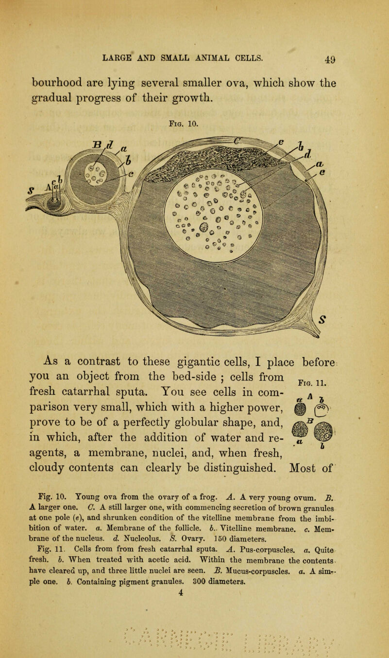 bourhood are lying several smaller ova, which show the gradual progress of their growth. Fig. 10. As a contrast to these gigantic cells, I place before you an object from the bed-side ; cells from fresh catarrhal sputa. You see cells in com- parison very small, which with a higher power, prove to be of a perfectly globular shape, and, in which, after the addition of water and re- agents, a membrane, nuclei, and, when fresh, cloudy contents can clearly be distinguished. Most of Fig. 11. a Fig. 10. Young ova from the ovary of a frog. A. A very young ovum. B. A larger one. G. A still larger one, with commencing secretion of brown granules at one pole (e), and shrunken condition of the vitelline membrane from the imbi- bition of water, a. Membrane of the follicle, b.. Vitelline membrane, c. Mem- brane of the nucleus, d. Nucleolus. S. Ovary. 150 diameters. Fig. 11. Cells from from fresh catarrhal sputa. A. Pus-corpuscles, a. Quite fresh, b. When treated with acetic acid. Within the membrane the contents- have cleared up, and three little nuclei are seen. B. Mucus-corpuscles, a. A sim-- ple one. b. Containing pigment granules. 300 diameters. 4
