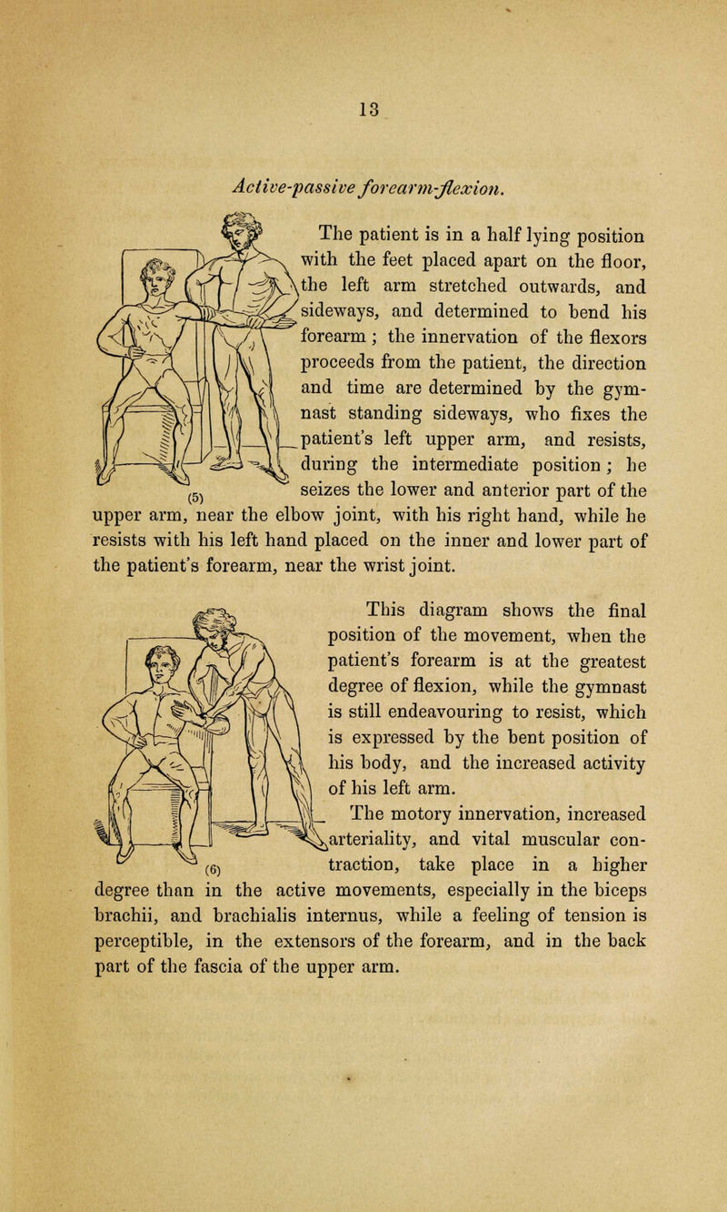 Active-passive forearm-flexion. The patient is in a half lying position with the feet placed apart on the floor, .the left arm stretched outwards, and sideways, and determined to bend his forearm ; the innervation of the flexors proceeds from the patient, the direction and time are determined by the gym- nast standing sideways, who fixes the patient's left upper arm, and resists, during the intermediate position; he seizes the lower and anterior part of the upper arm, near the elbow joint, with his right hand, while he resists with his left hand placed on the inner and lower part of the patient's forearm, near the wrist joint. This diagram shows the final position of the movement, when the patient's forearm is at the greatest degree of flexion, while the gymnast is still endeavouring to resist, which is expressed by the bent position of his body, and the increased activity of his left arm. |_ The motory innervation, increased ^arteriality, and vital muscular con- traction, take place in a higher degree than in the active movements, especially in the biceps brachii, and brachialis internus, while a feeling of tension is perceptible, in the extensors of the forearm, and in the back part of the fascia of the upper arm.