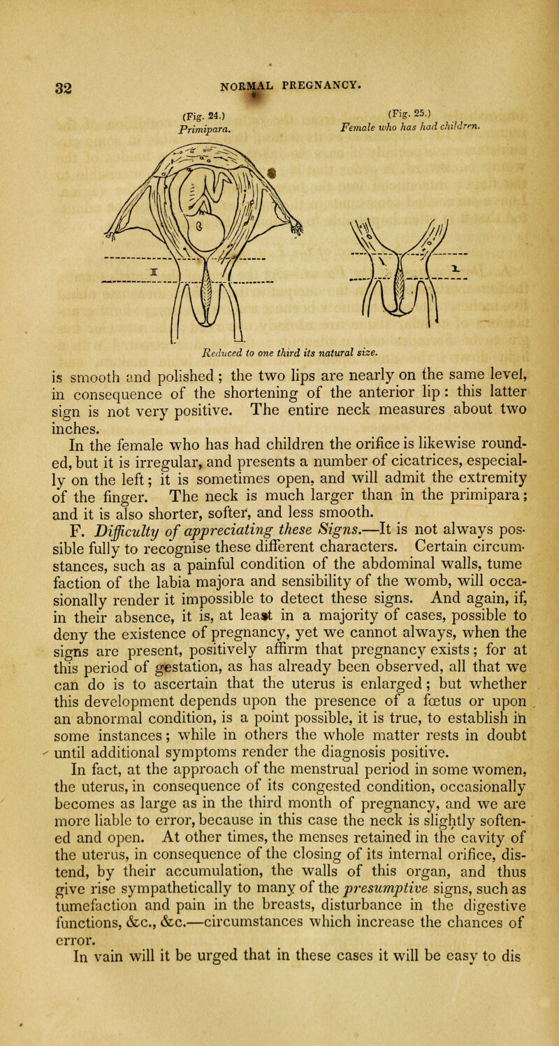 (Fig. 24.) Primipara. (Fig. 25.) Female who has had children. Reduced to one third its natural size. is smooth and polished ; the two lips are nearly on the same level, in consequence of the shortening of the anterior lip: this latter sign is not very positive. The entire neck measures about two inches. In the female who has had children the orifice is likewise round- ed, but it is irregular, and presents a number of cicatrices, especial- ly on the left; it is sometimes open, and will admit the extremity of the finger. The neck is much larger than in the primipara; and it is also shorter, softer, and less smooth. F. Difficulty of appreciating these Signs.—It is not always pos- sible fully to recognise these different characters. Certain circum- stances, such as a painful condition of the abdominal walls, tume faction of the labia majora and sensibility of the womb, will occa- sionally render it impossible to detect these signs. And again, if, in their absence, it is, at least in a majority of cases, possible to deny the existence of pregnancy, yet we cannot always, when the signs are present, positively affirm that pregnancy exists; for at this period of gestation, as has already been observed, all that we can do is to ascertain that the uterus is enlarged; but whether this development depends upon the presence of a foetus or upon an abnormal condition, is a point possible, it is true, to establish in some instances; while in others the whole matter rests in doubt until additional symptoms render the diagnosis positive. In fact, at the approach of the menstrual period in some women, the uterus, in consequence of its congested condition, occasionally becomes as large as in the third month of pregnancy, and we are more liable to error, because in this case the neck is slightly soften- ed and open. At other times, the menses retained in the cavity of the uterus, in consequence of the closing of its internal orifice, dis- tend, by their accumulation, the walls of this organ, and thus give rise sympathetically to many of the presumptive signs, such as tumefaction and pain in the breasts, disturbance in the digestive functions, &c, &c.—circumstances which increase the chances of error. In vain will it be urged that in these cases it will be easy to dis